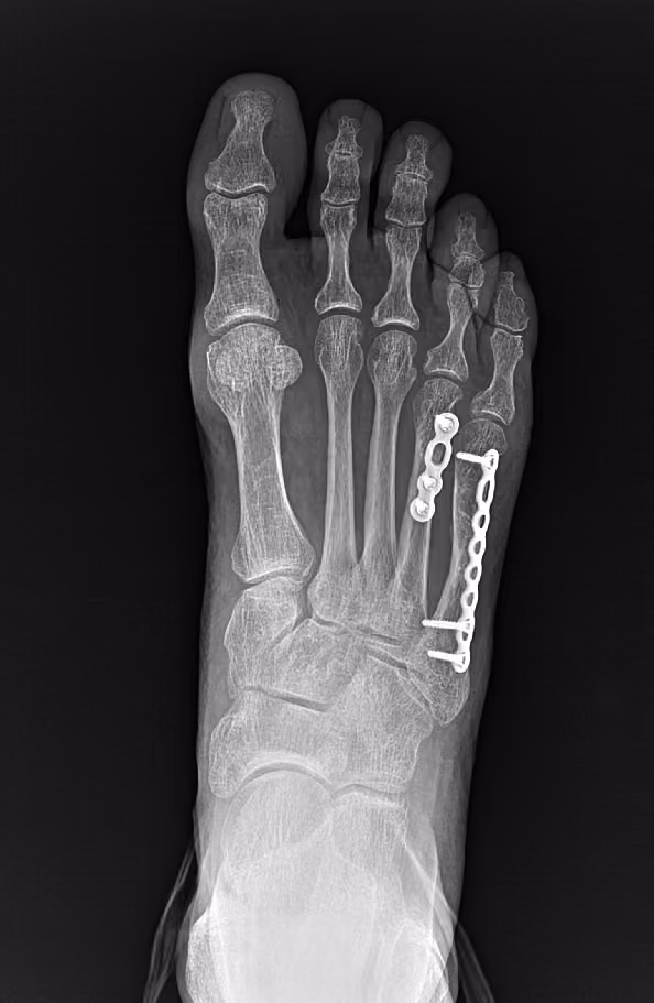 X-ray of a foot after fracture repair with a plate and screws