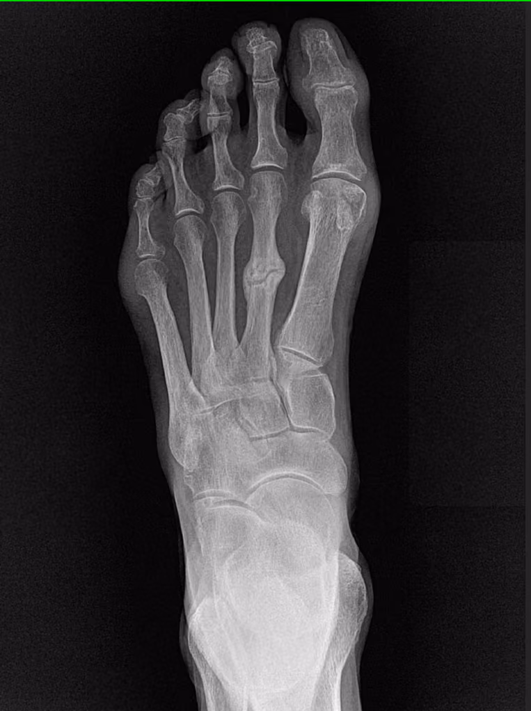 X-ray of a foot with a healing stress fracture