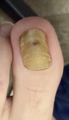 Toenail thickened and discolored by fungus before laser treatment