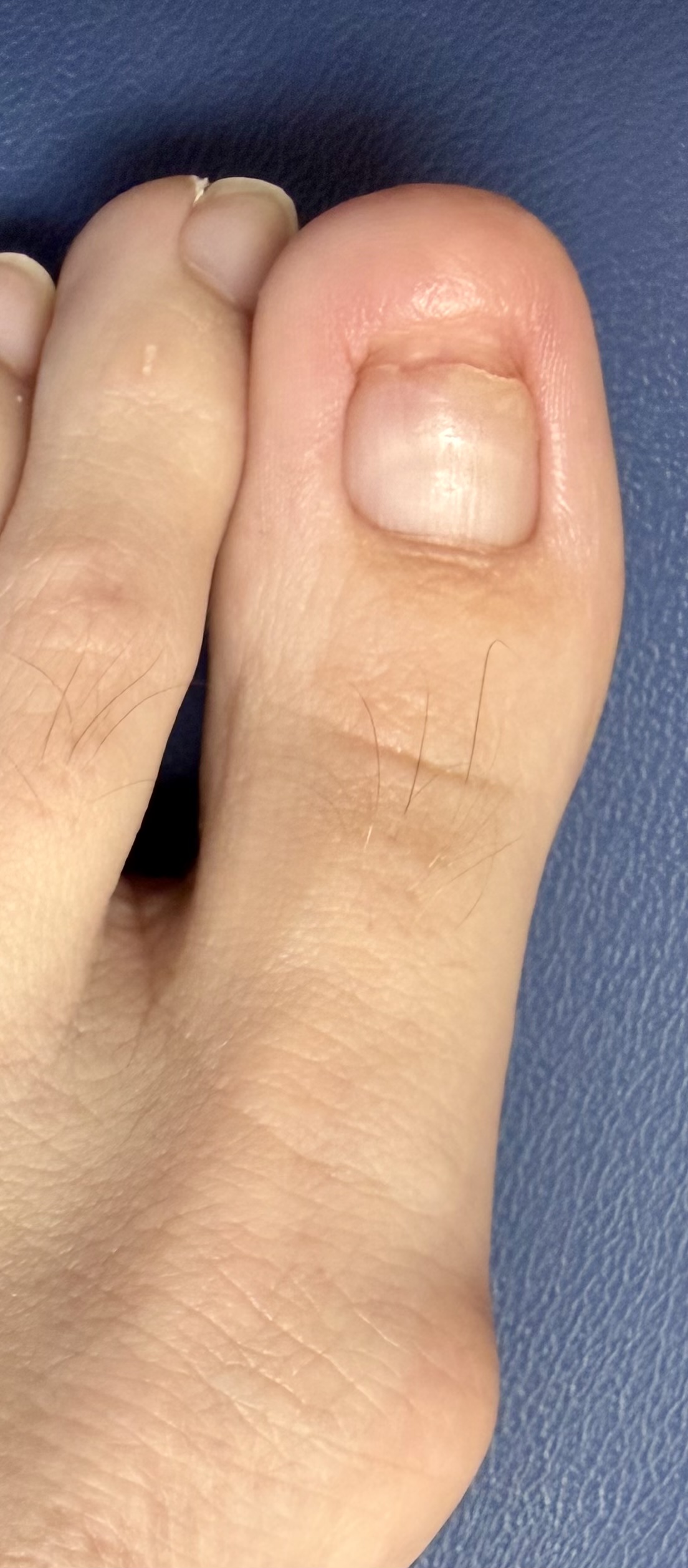Clear, healthy toenail after laser treatment for toenail fungus