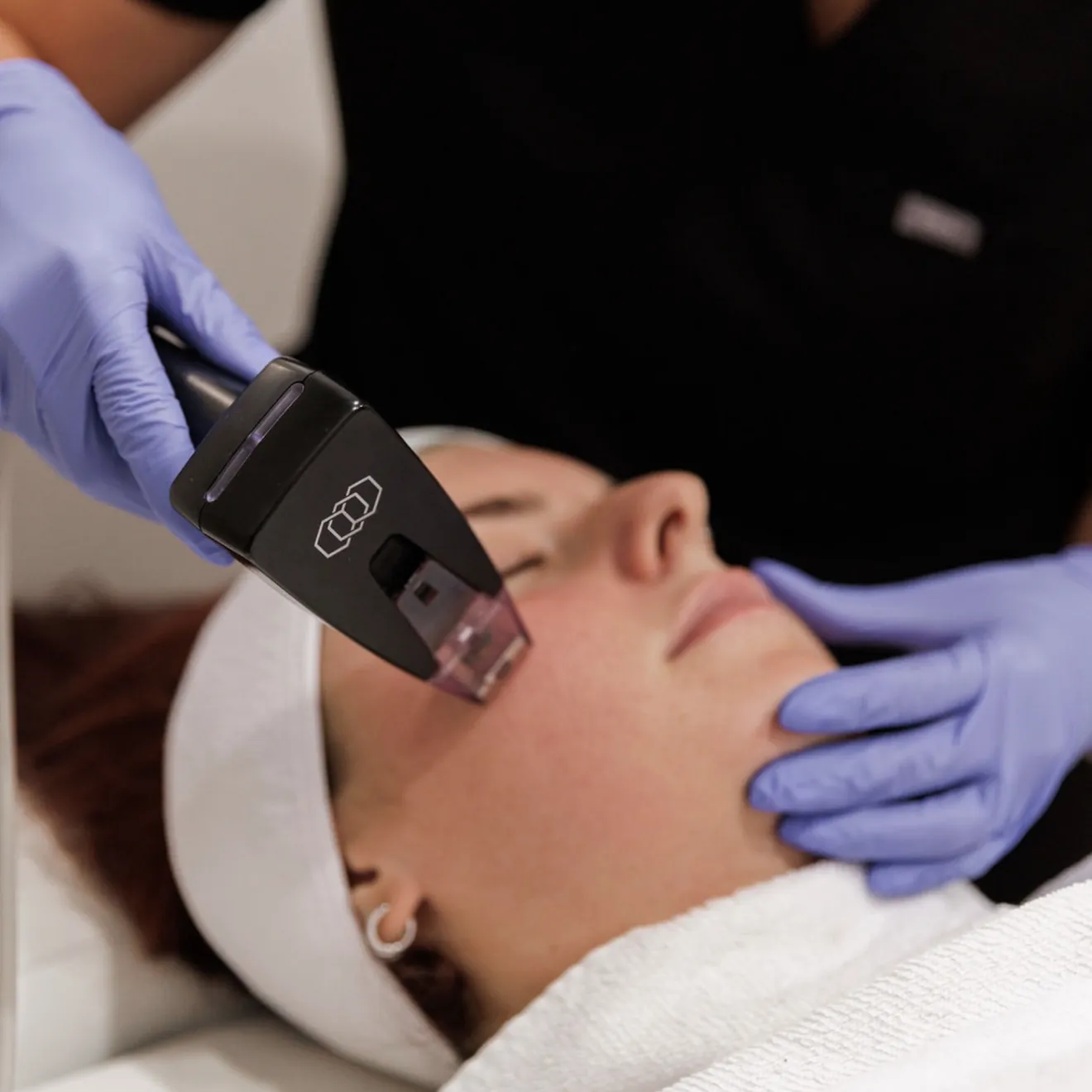 Provider performing laser hair removal on a client's face with a diode laser
