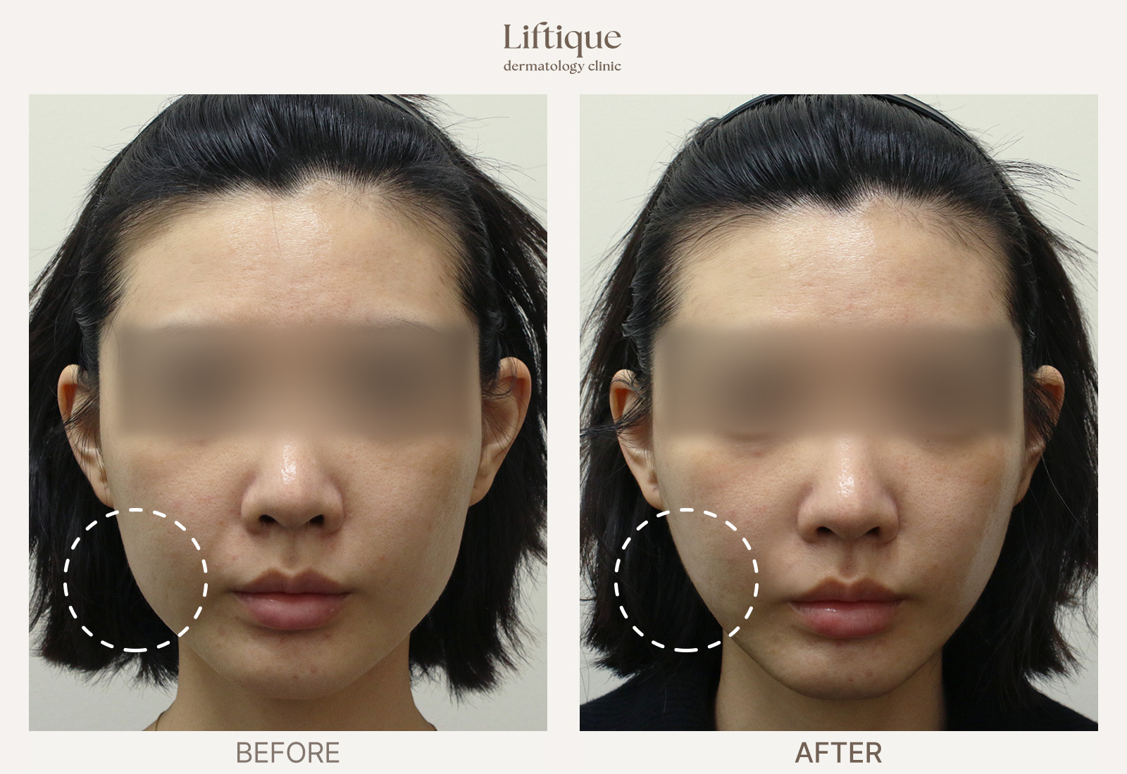 Before-and-after result 1 for Ultherapy Prime at Liftique Dermatology Clinic