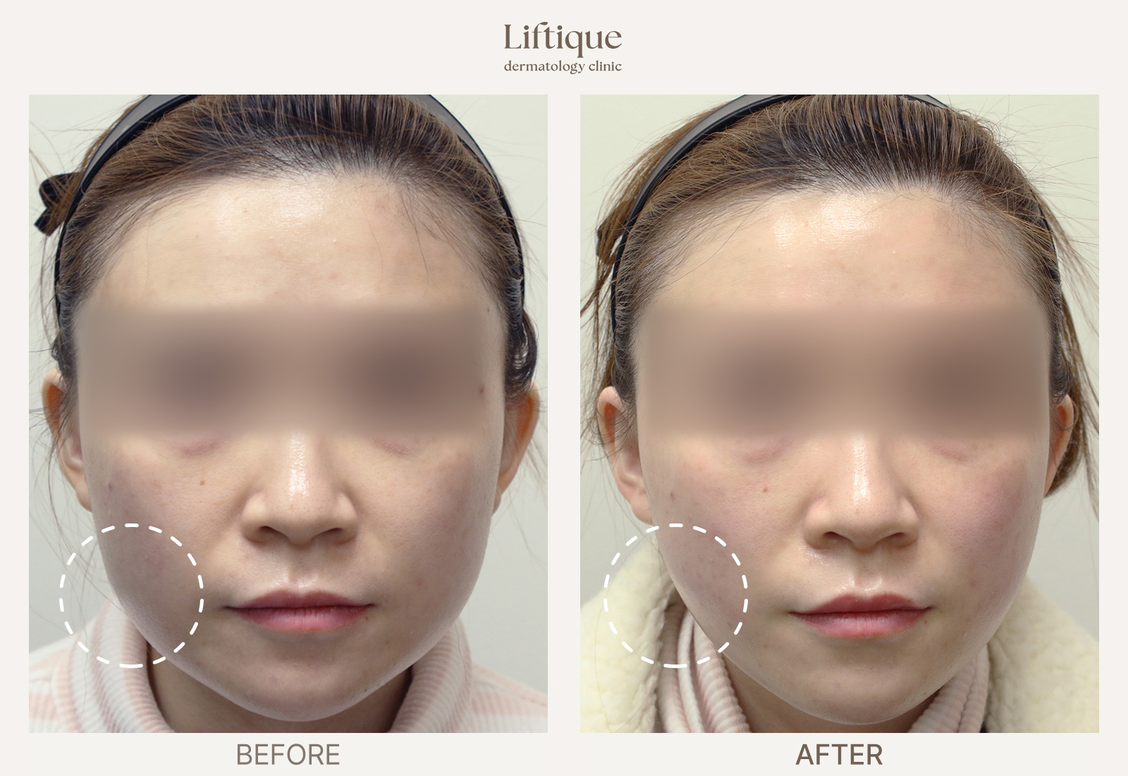 Before-and-after result 2 for Ultherapy Prime at Liftique Dermatology Clinic