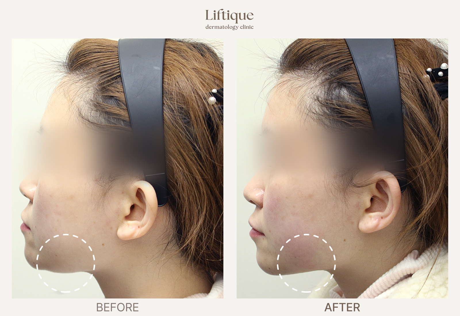 Before-and-after result 3 for Ultherapy Prime at Liftique Dermatology Clinic