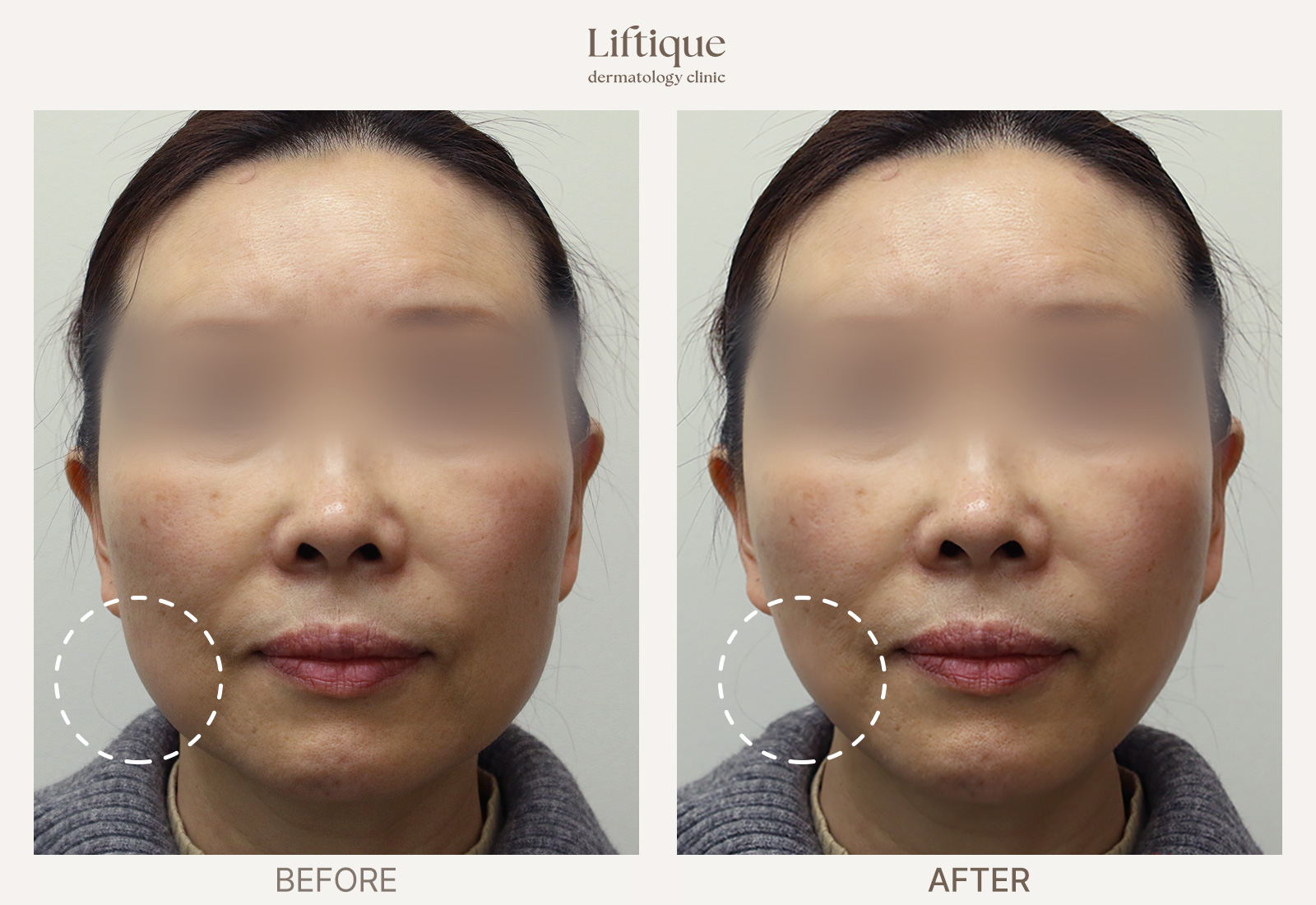 Before-and-after result 4 for Ultherapy Prime at Liftique Dermatology Clinic