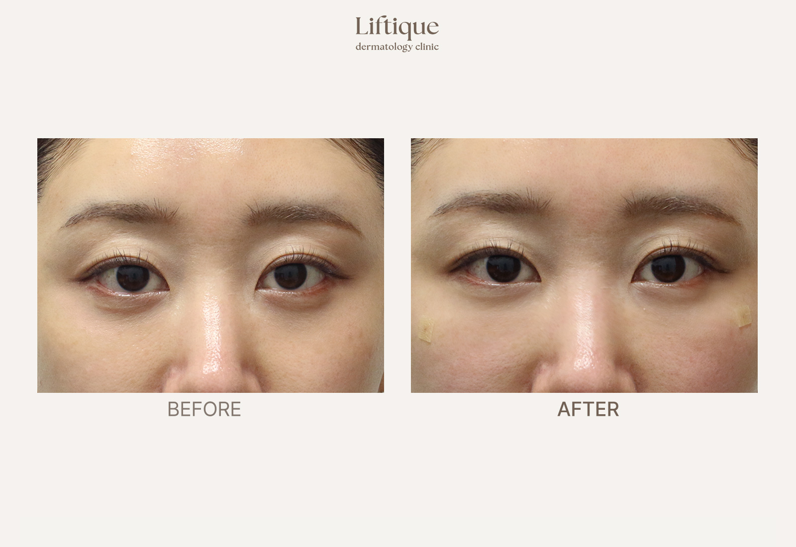 Before-and-after result 1 for Eye Thermage at Liftique Dermatology Clinic