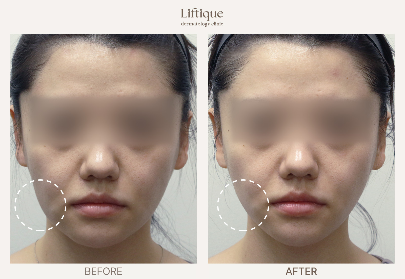 Before-and-after result 1 for ONDA at Liftique Dermatology Clinic