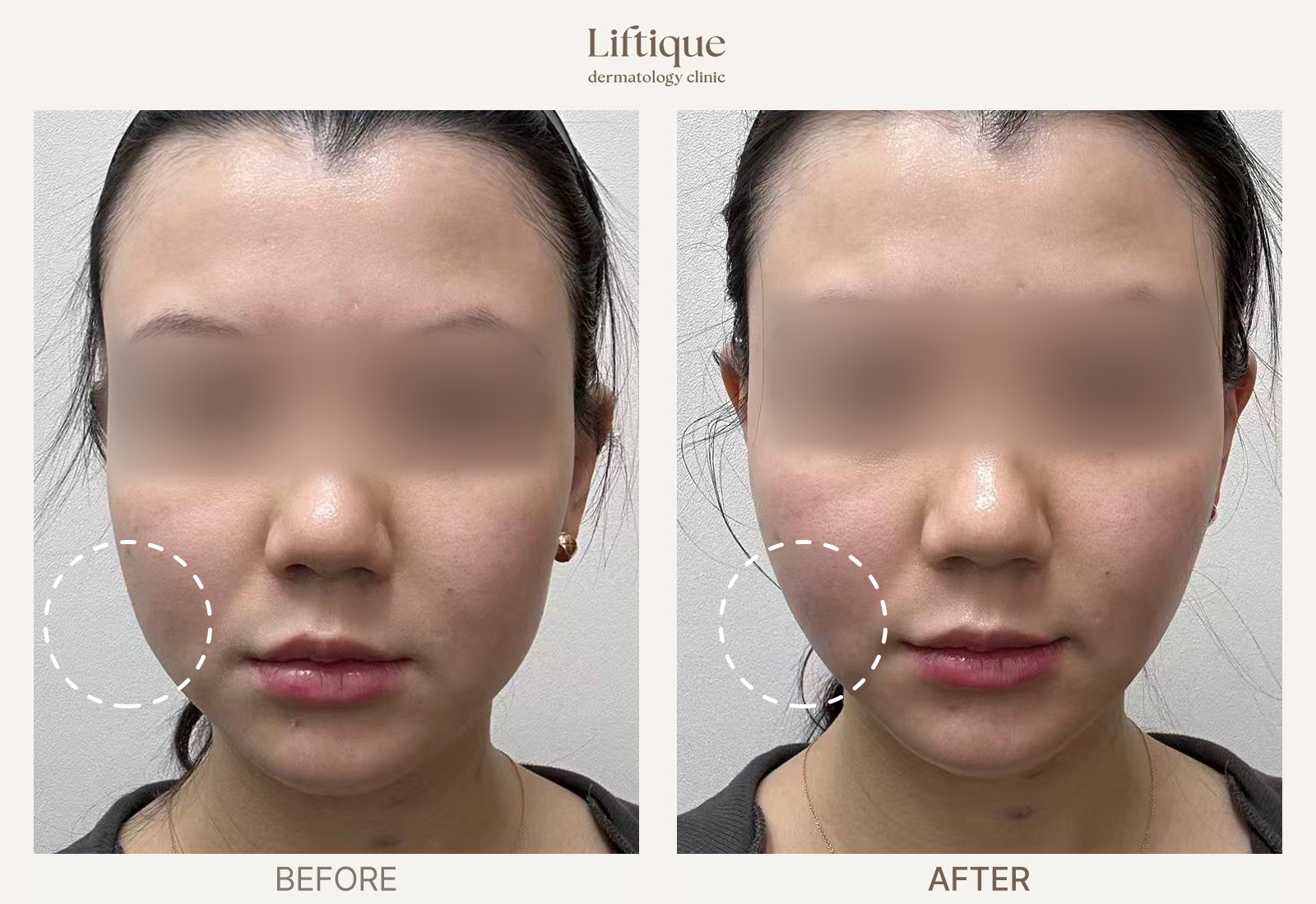 Before-and-after result 2 for ONDA at Liftique Dermatology Clinic