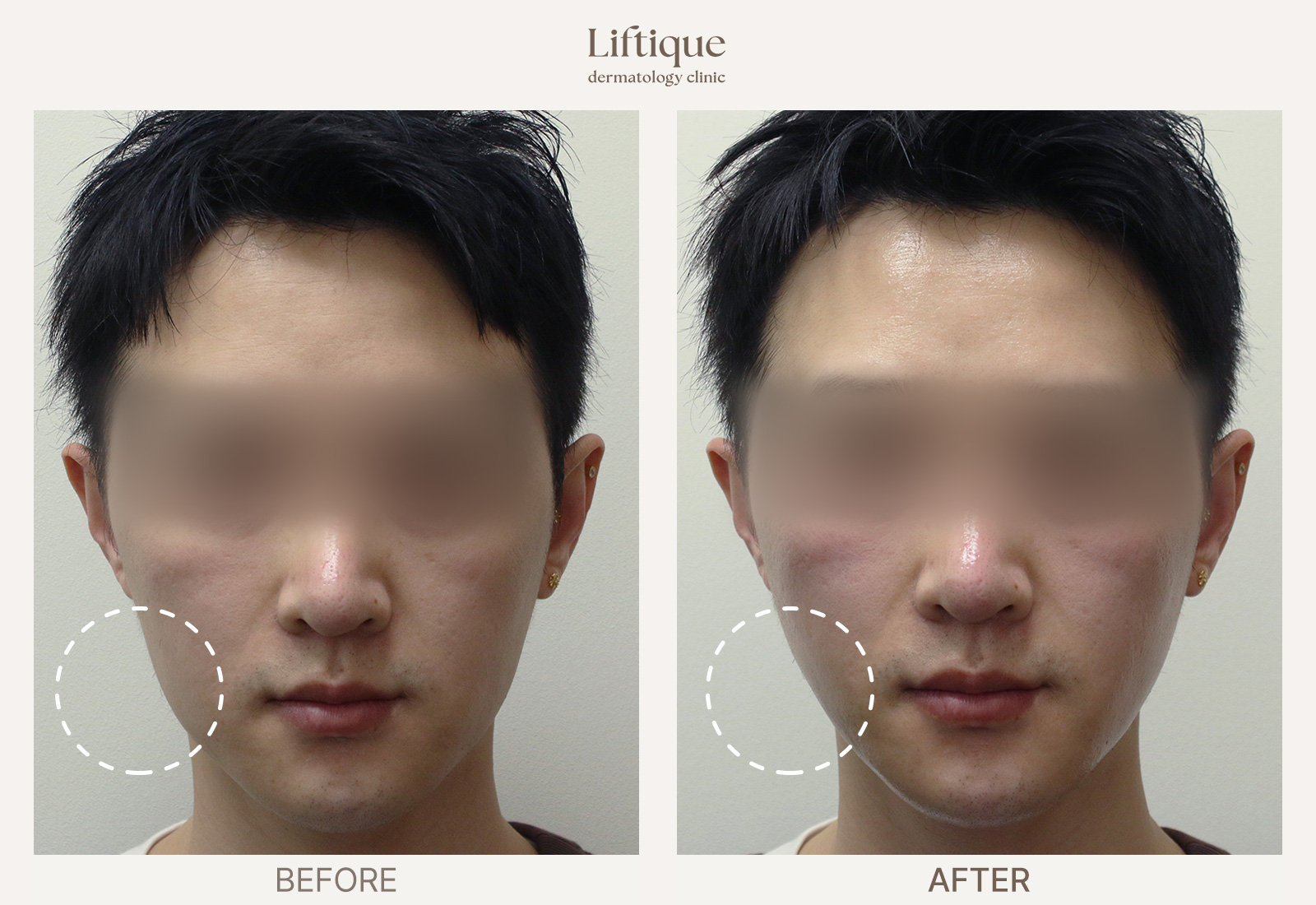 Before-and-after result 3 for ONDA at Liftique Dermatology Clinic