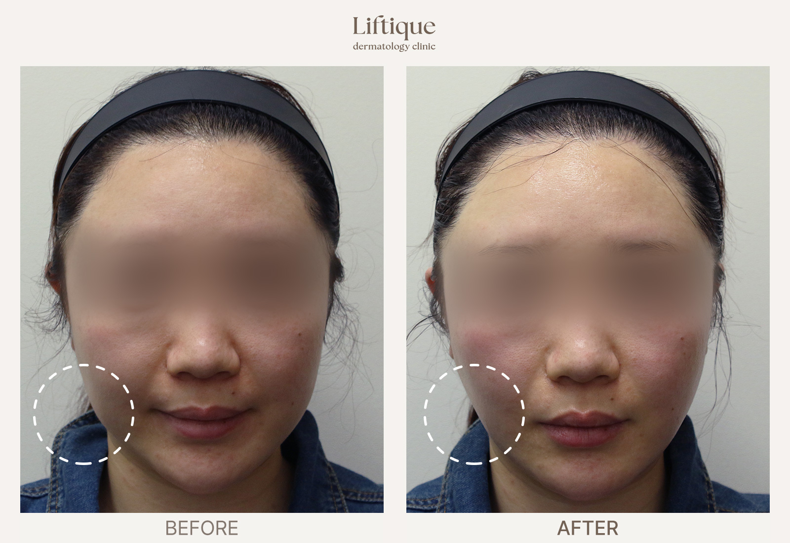 Before-and-after result 5 for ONDA at Liftique Dermatology Clinic