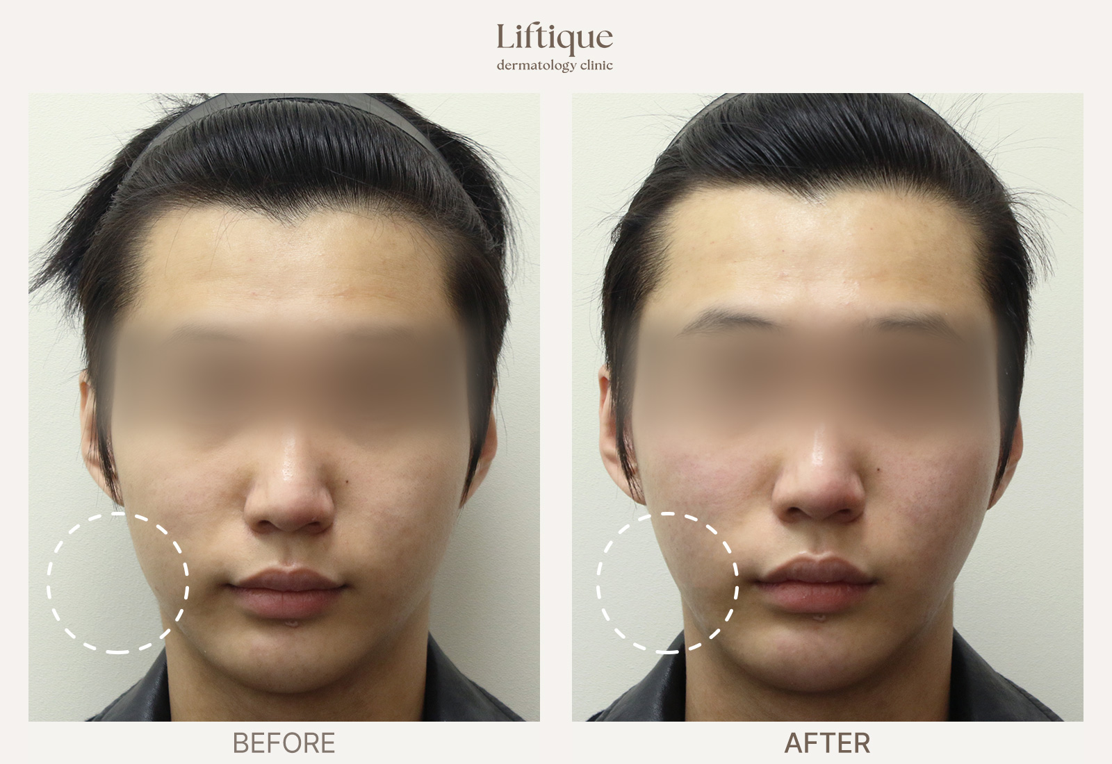 Before-and-after result 4 for ONDA at Liftique Dermatology Clinic