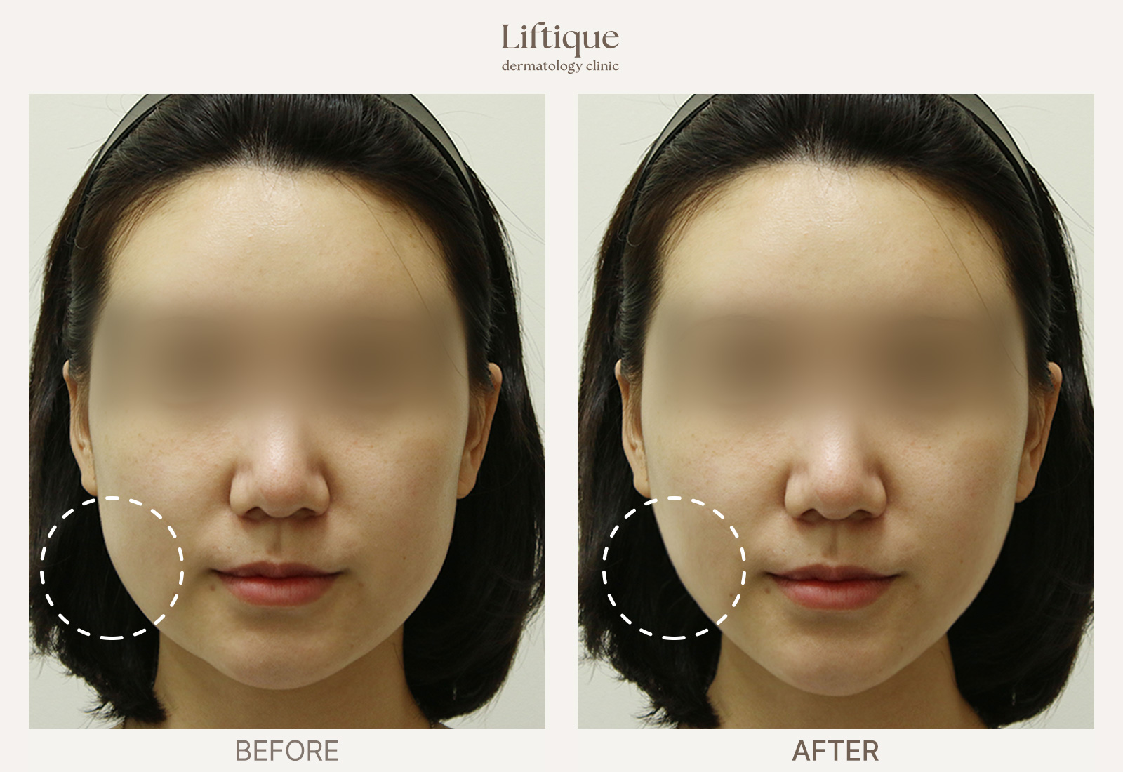Before-and-after result 6 for ONDA at Liftique Dermatology Clinic