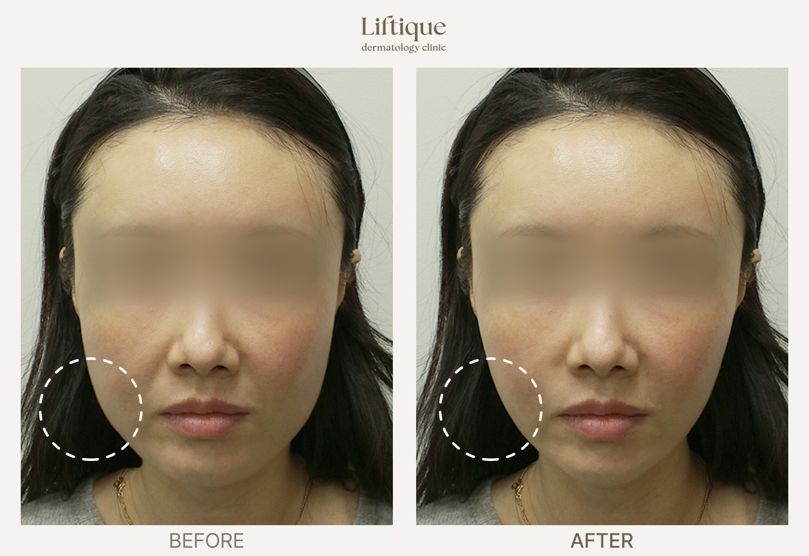 Before-and-after result 7 for ONDA at Liftique Dermatology Clinic