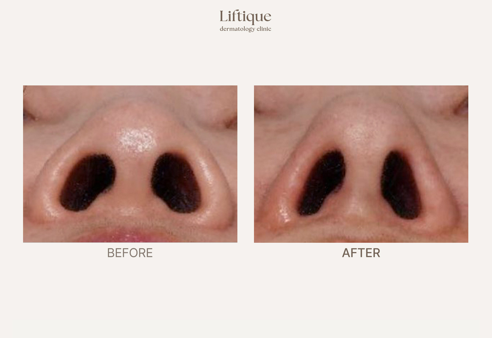 Before-and-after result 1 for Thread Lifting at Liftique Dermatology Clinic