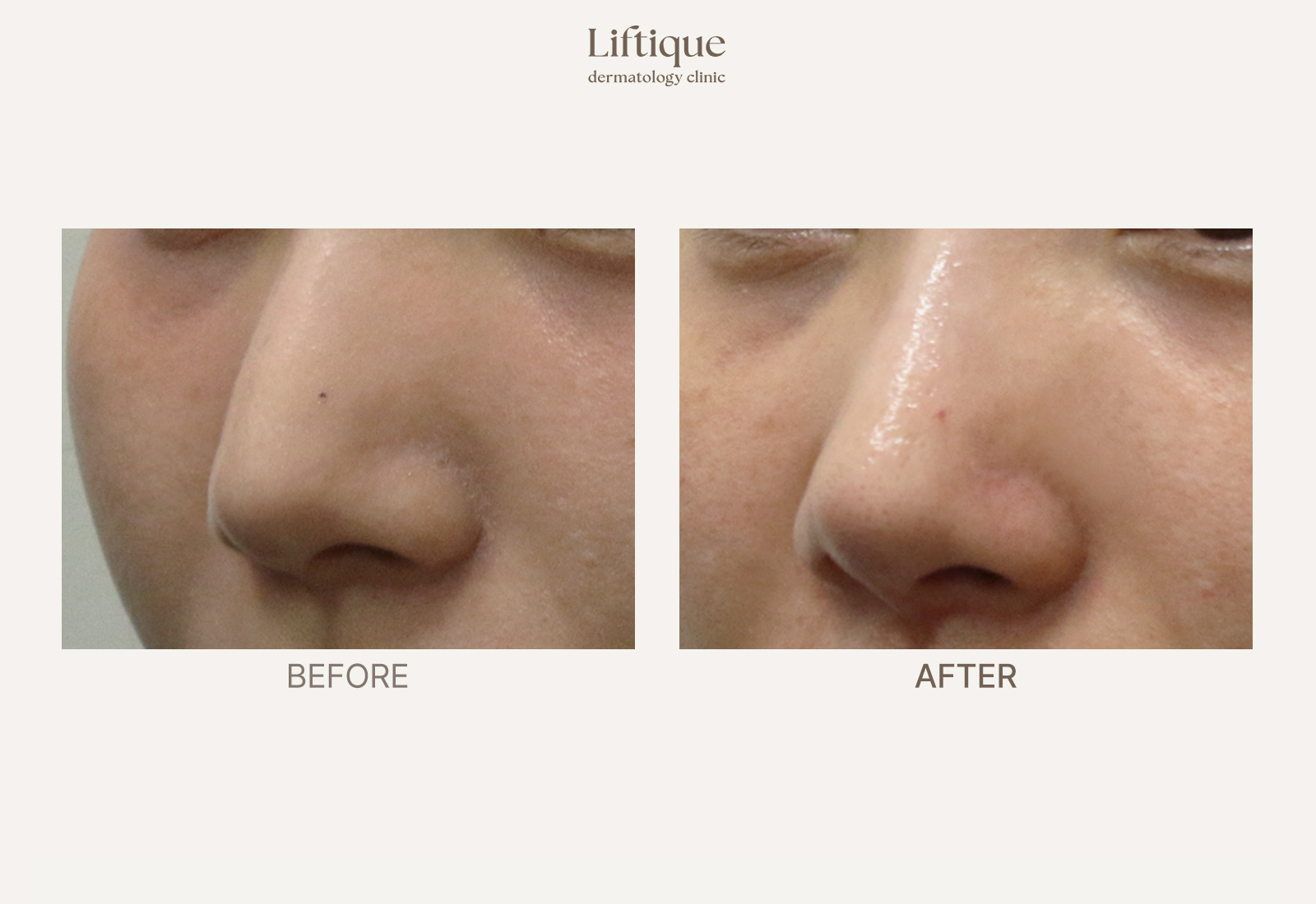 Before-and-after result 3 for Thread Lifting at Liftique Dermatology Clinic