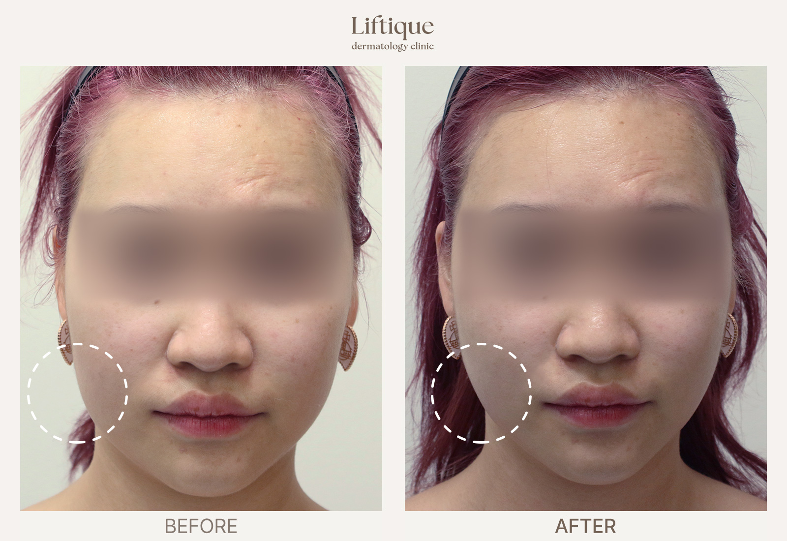 Before-and-after result 4 for Thread Lifting at Liftique Dermatology Clinic