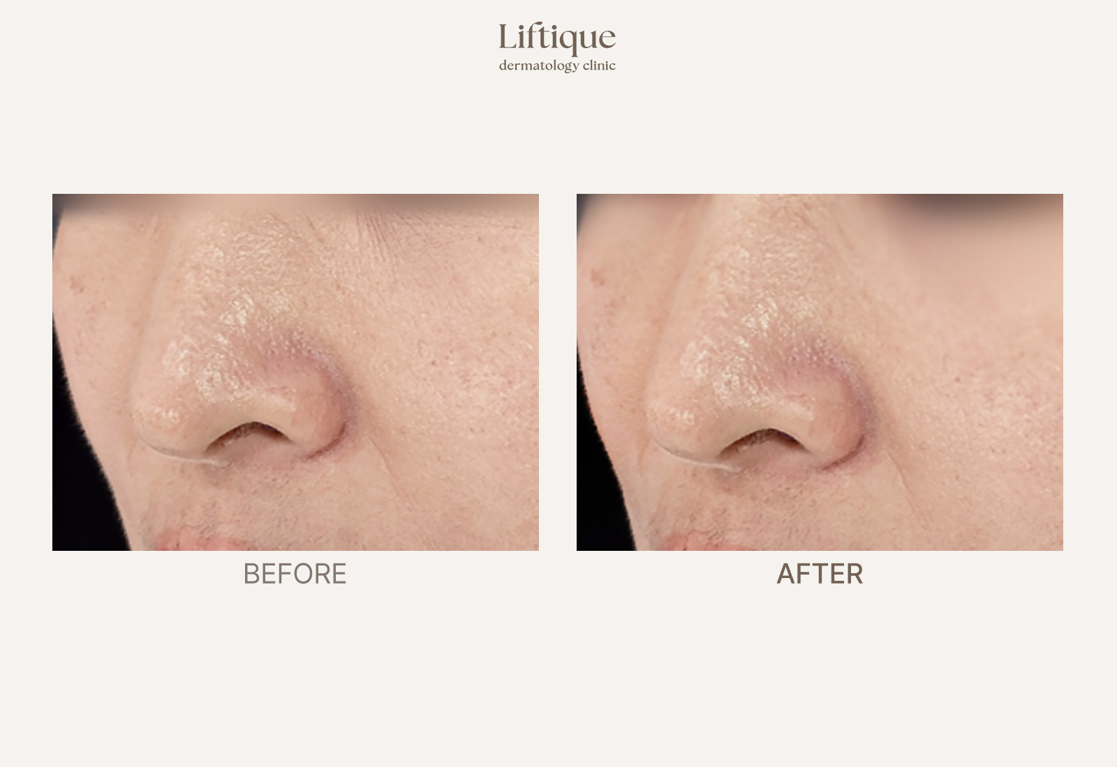 Before-and-after result 6 for Thread Lifting at Liftique Dermatology Clinic