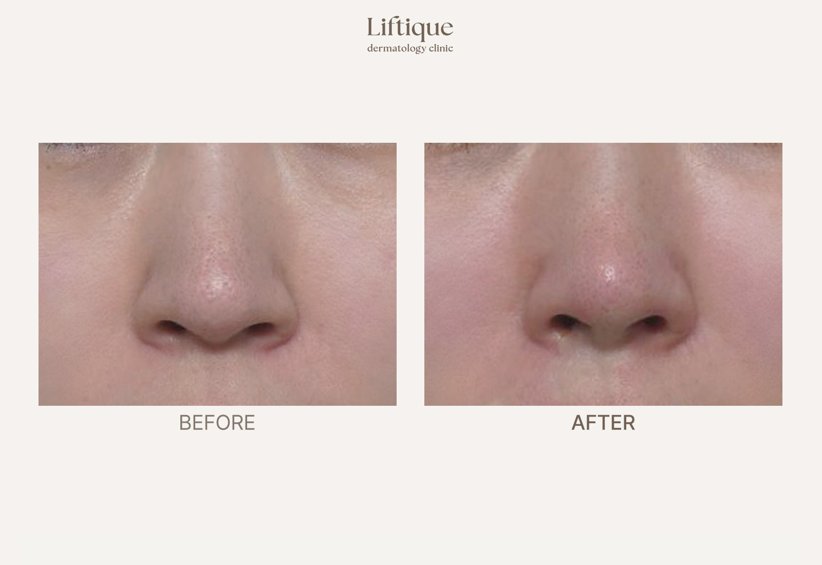 Before-and-after result 5 for Thread Lifting at Liftique Dermatology Clinic