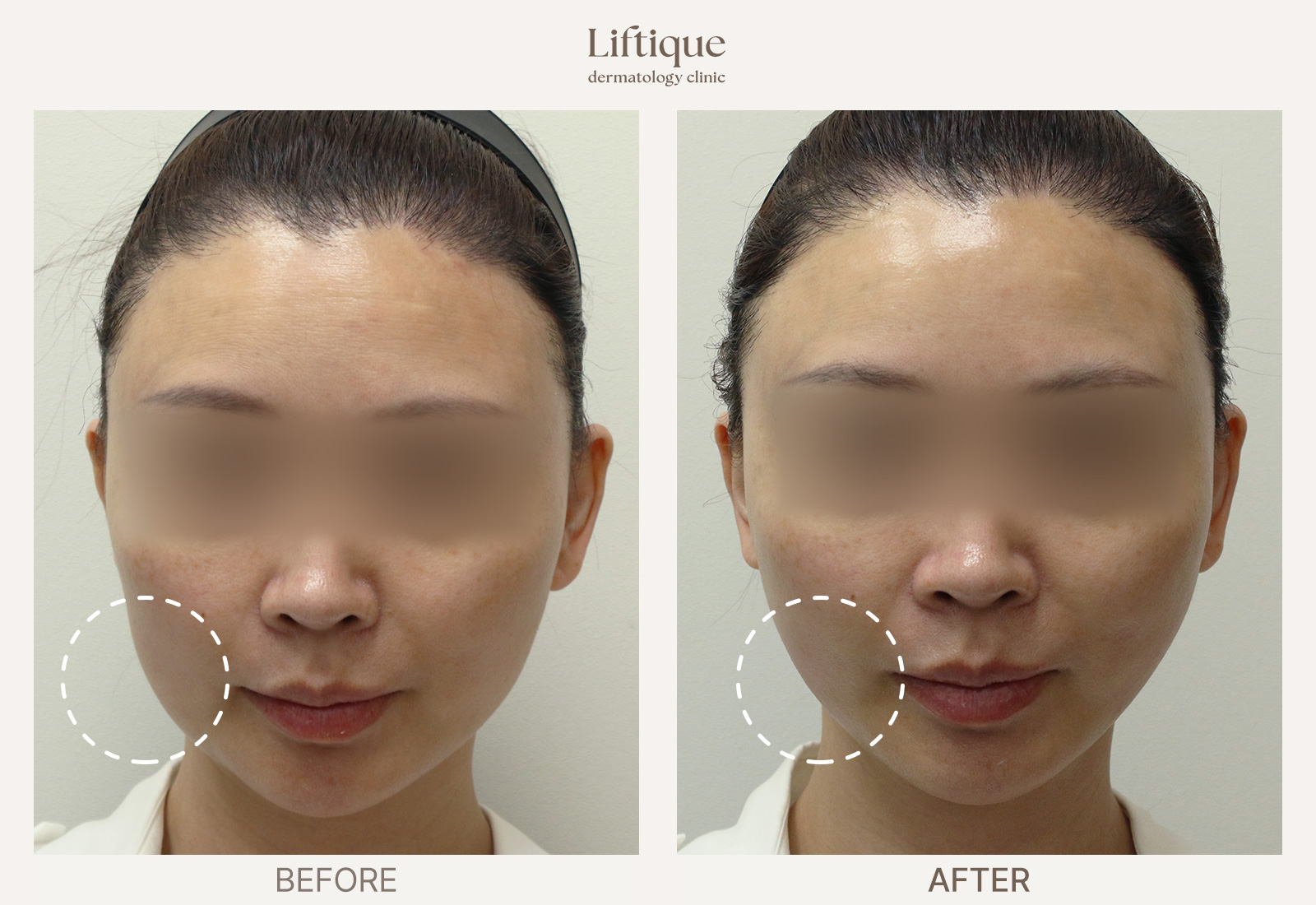 Before-and-after result 2 for Thread Lifting at Liftique Dermatology Clinic