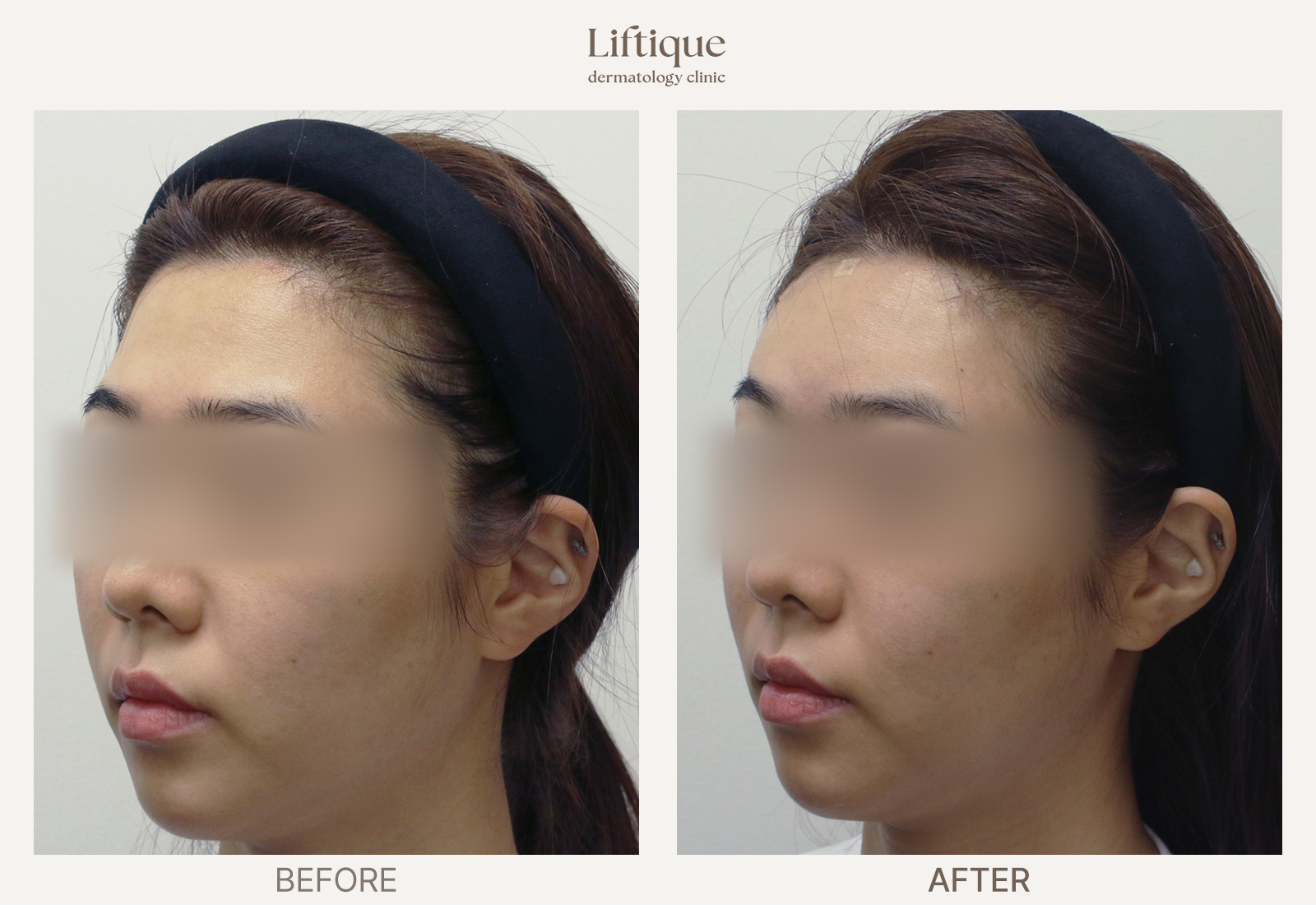 Before-and-after result 1 for Hyaluronic Acid Filler at Liftique Dermatology Clinic