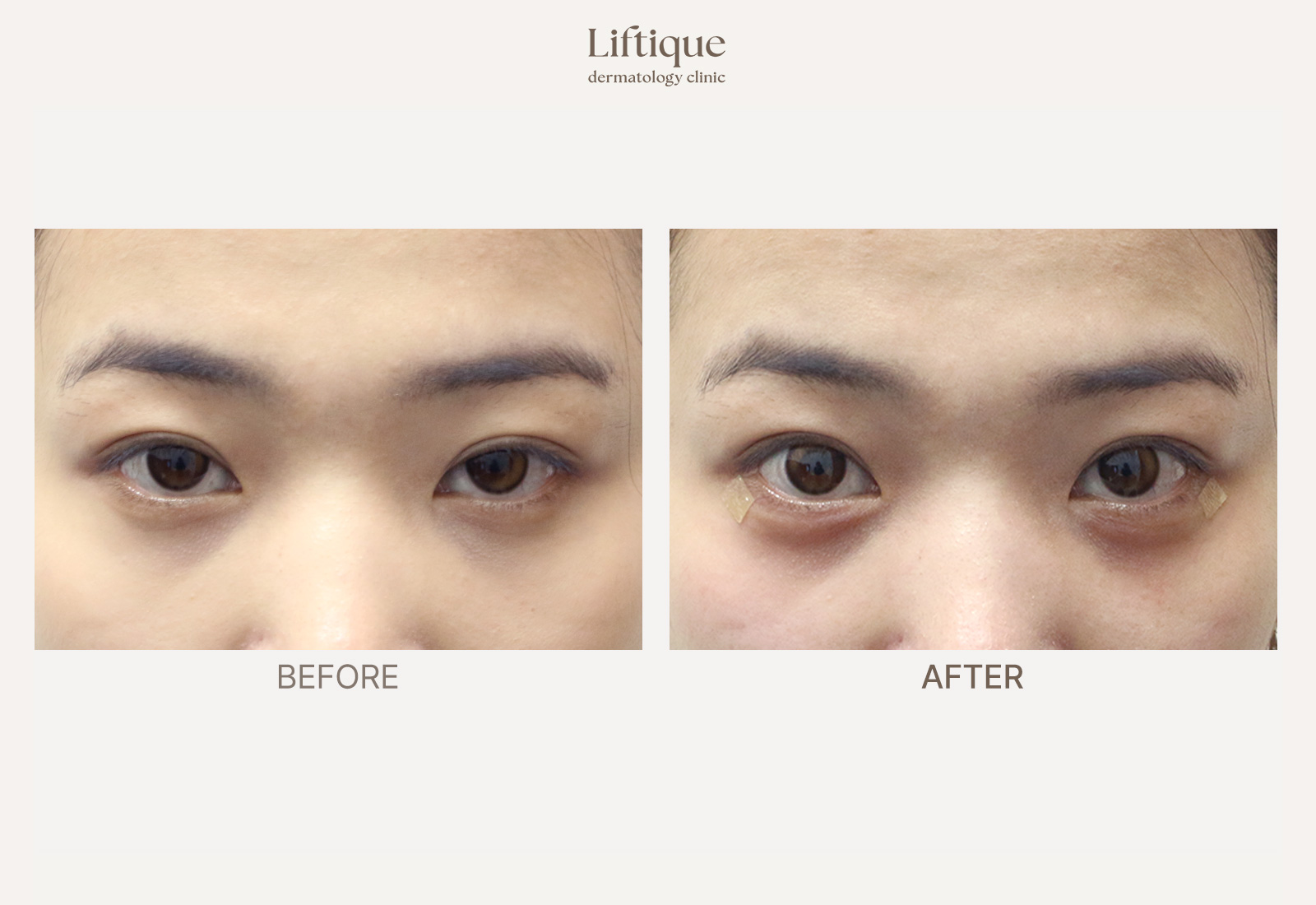 Before-and-after result 5 for Hyaluronic Acid Filler at Liftique Dermatology Clinic