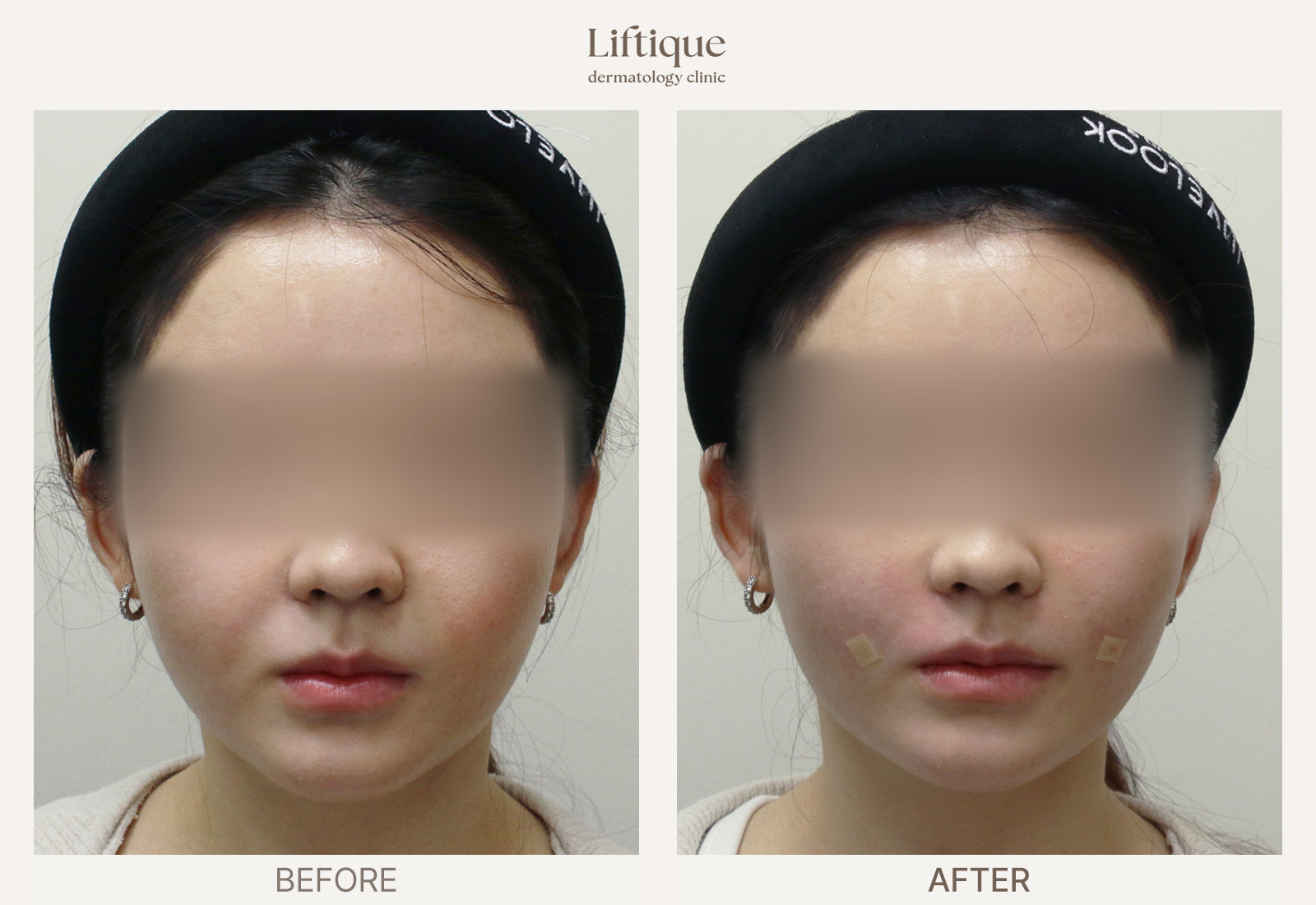 Before-and-after result 4 for Hyaluronic Acid Filler at Liftique Dermatology Clinic