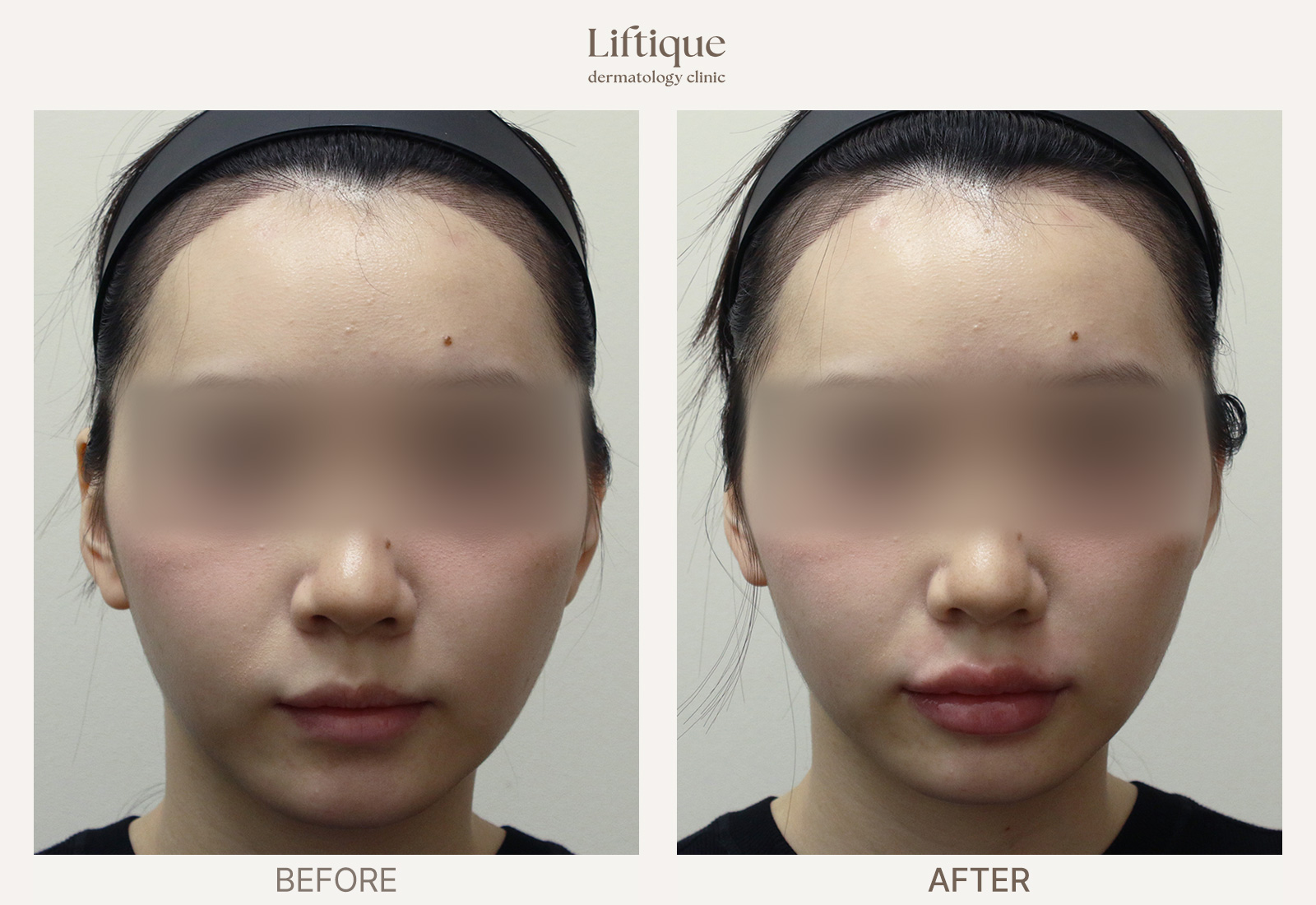 Before-and-after result 2 for Hyaluronic Acid Filler at Liftique Dermatology Clinic