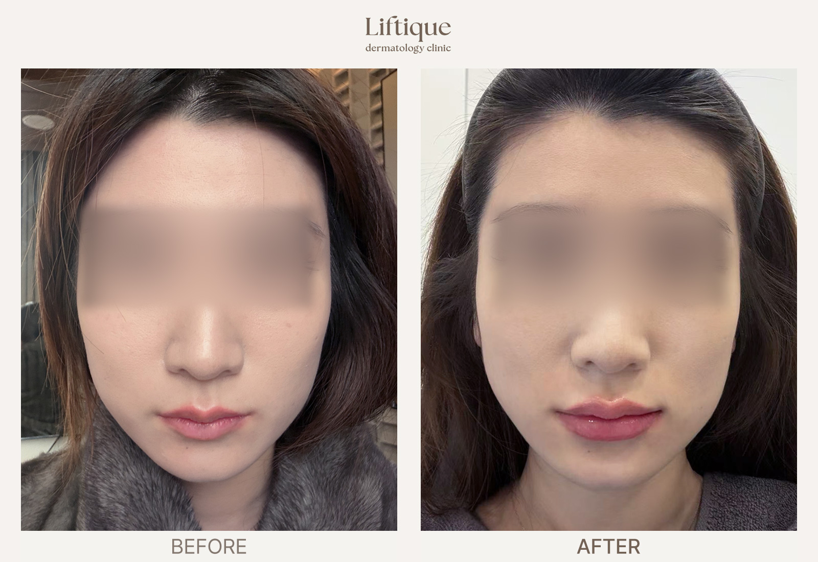 Before-and-after result 3 for Hyaluronic Acid Filler at Liftique Dermatology Clinic