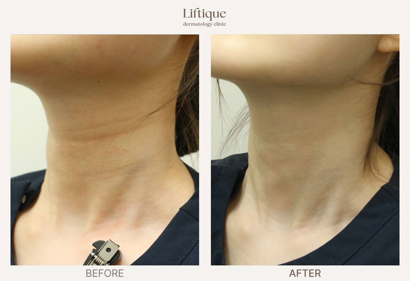 Before-and-after result 6 for Hyaluronic Acid Filler at Liftique Dermatology Clinic