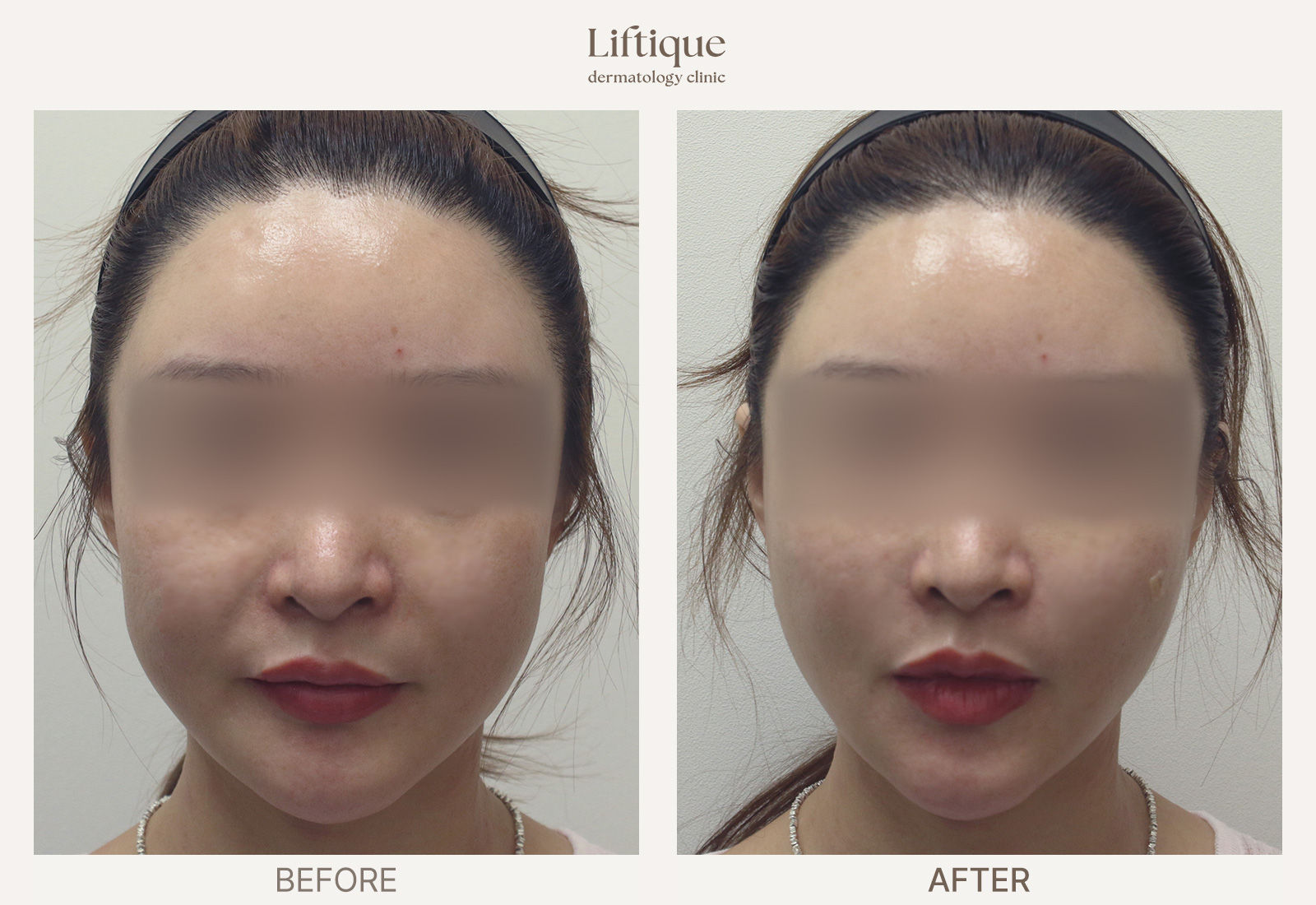 Before-and-after result 1 for Sculptra at Liftique Dermatology Clinic