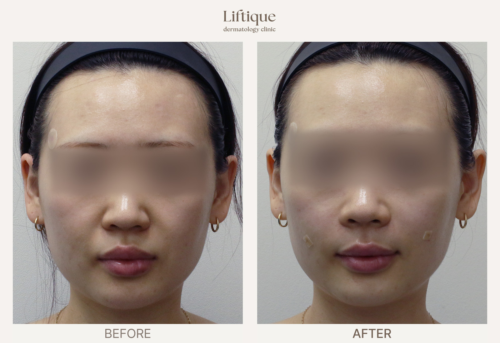 Before-and-after result 1 for Radiesse at Liftique Dermatology Clinic