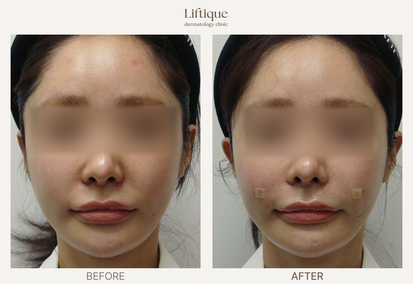 Before-and-after result 2 for Radiesse at Liftique Dermatology Clinic