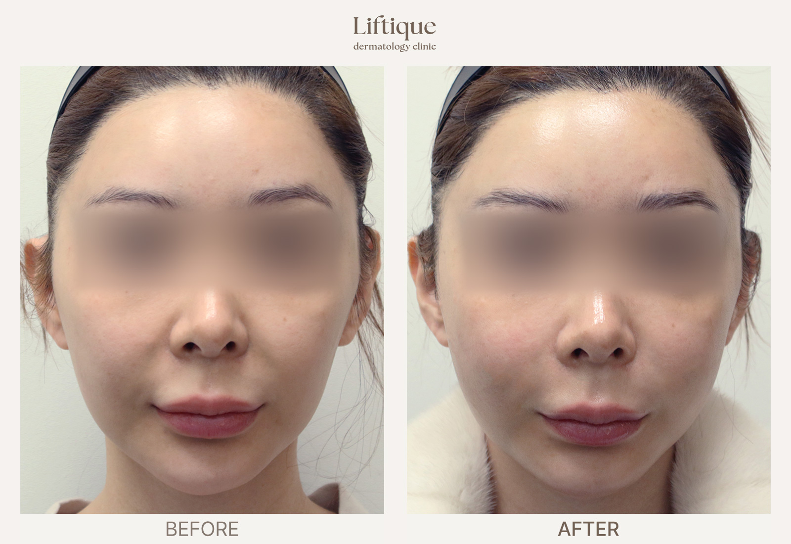 Before-and-after result 2 for Sculptra at Liftique Dermatology Clinic