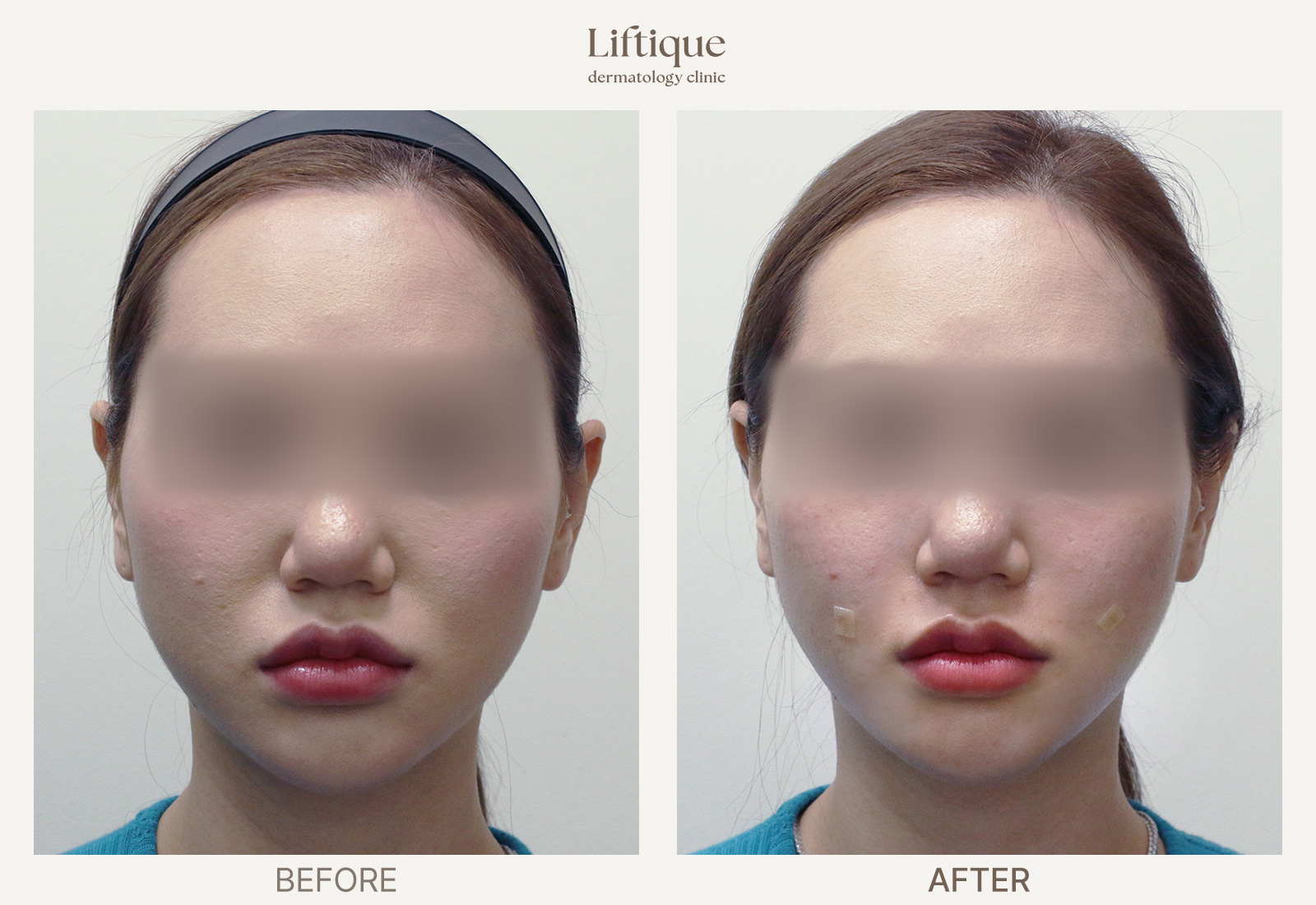 Before-and-after result 4 for Radiesse at Liftique Dermatology Clinic
