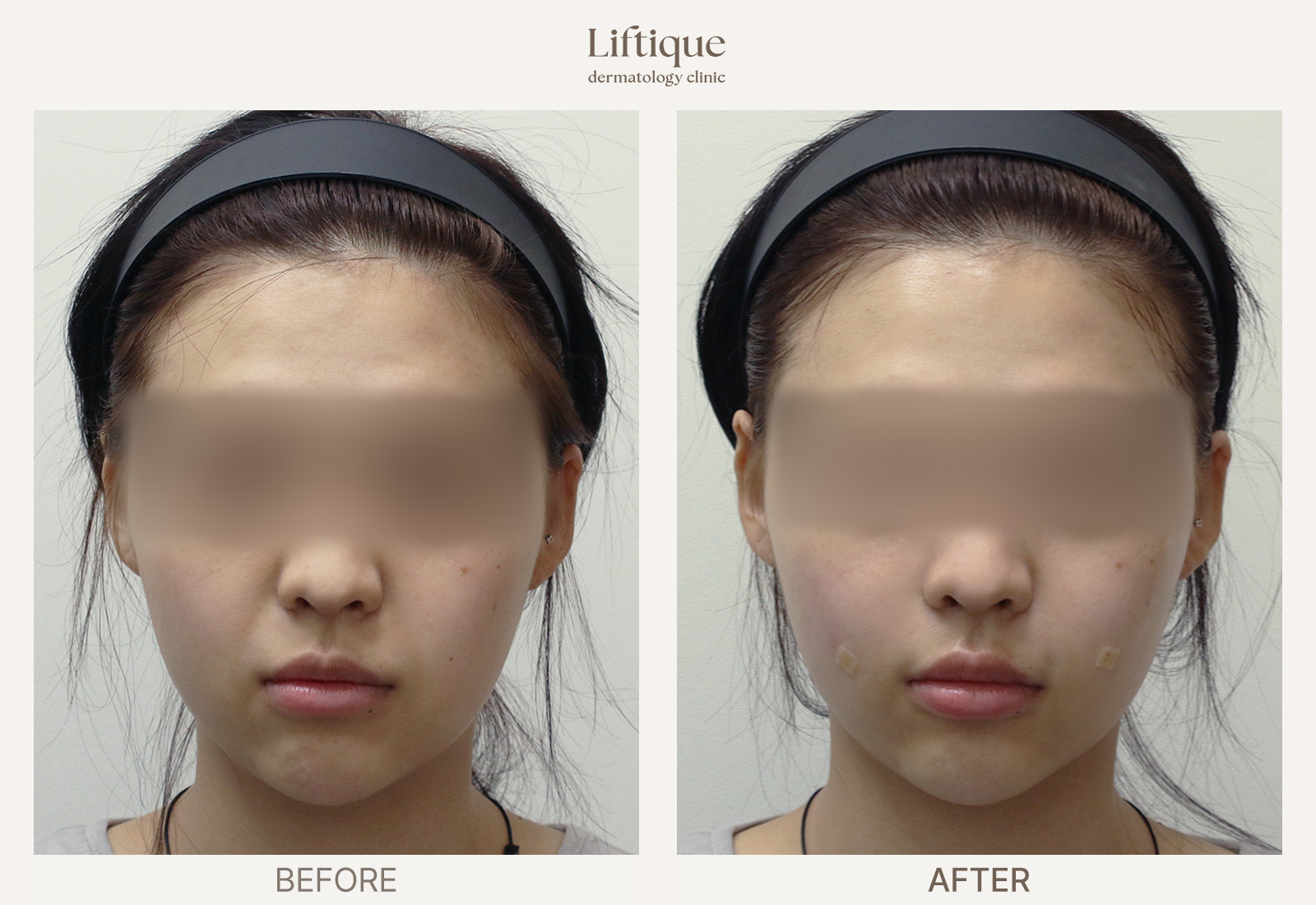 Before-and-after result 5 for Radiesse at Liftique Dermatology Clinic
