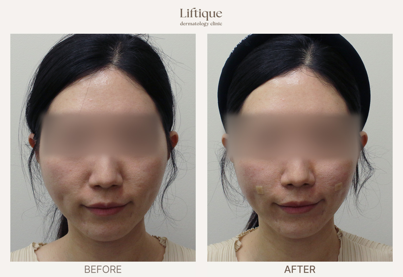 Before-and-after result 6 for Radiesse at Liftique Dermatology Clinic