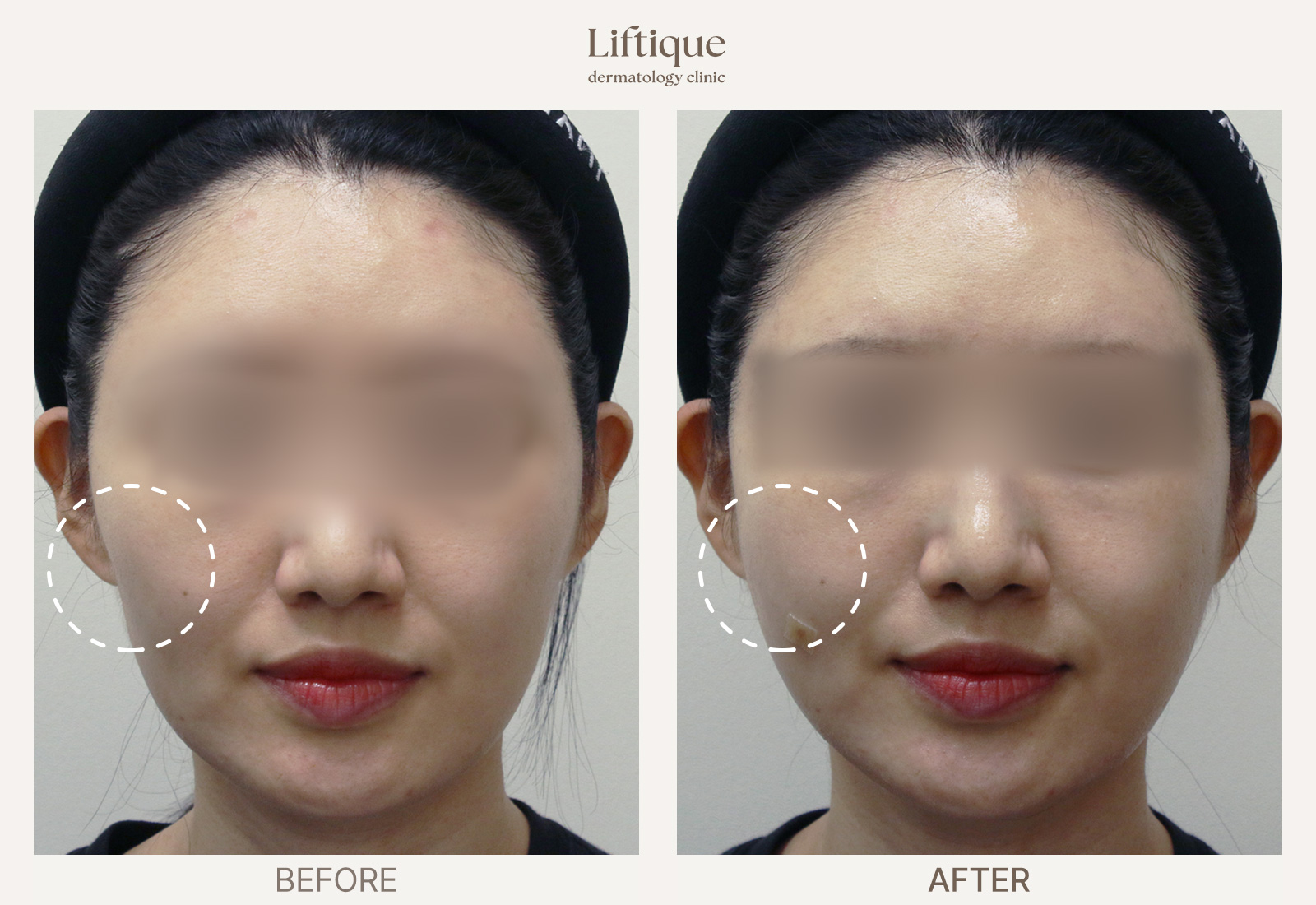 Before-and-after result 1 for Juvelook Volume at Liftique Dermatology Clinic