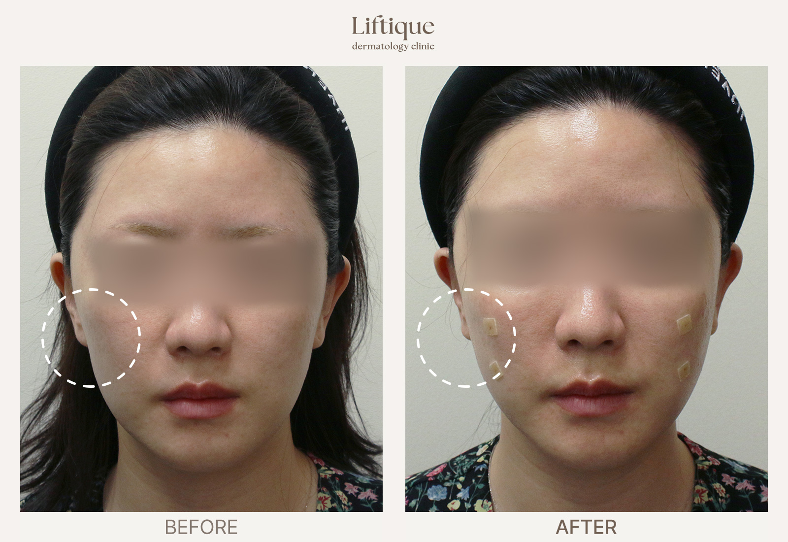 Before-and-after result 3 for Radiesse at Liftique Dermatology Clinic
