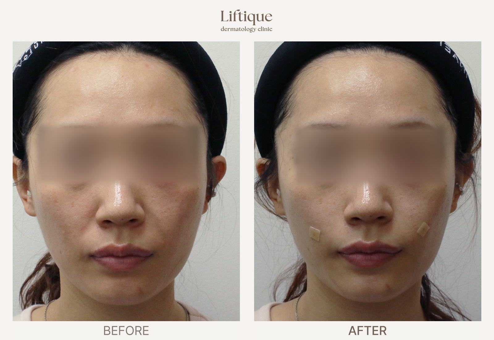 Before-and-after result 2 for Juvelook Volume at Liftique Dermatology Clinic
