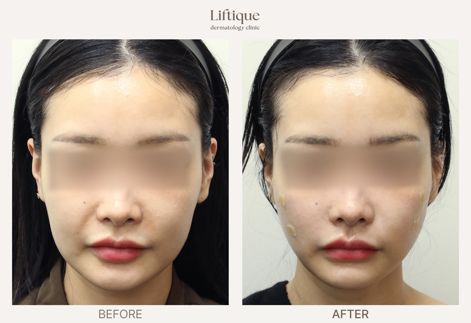 Before-and-after result 4 for Juvelook Volume at Liftique Dermatology Clinic