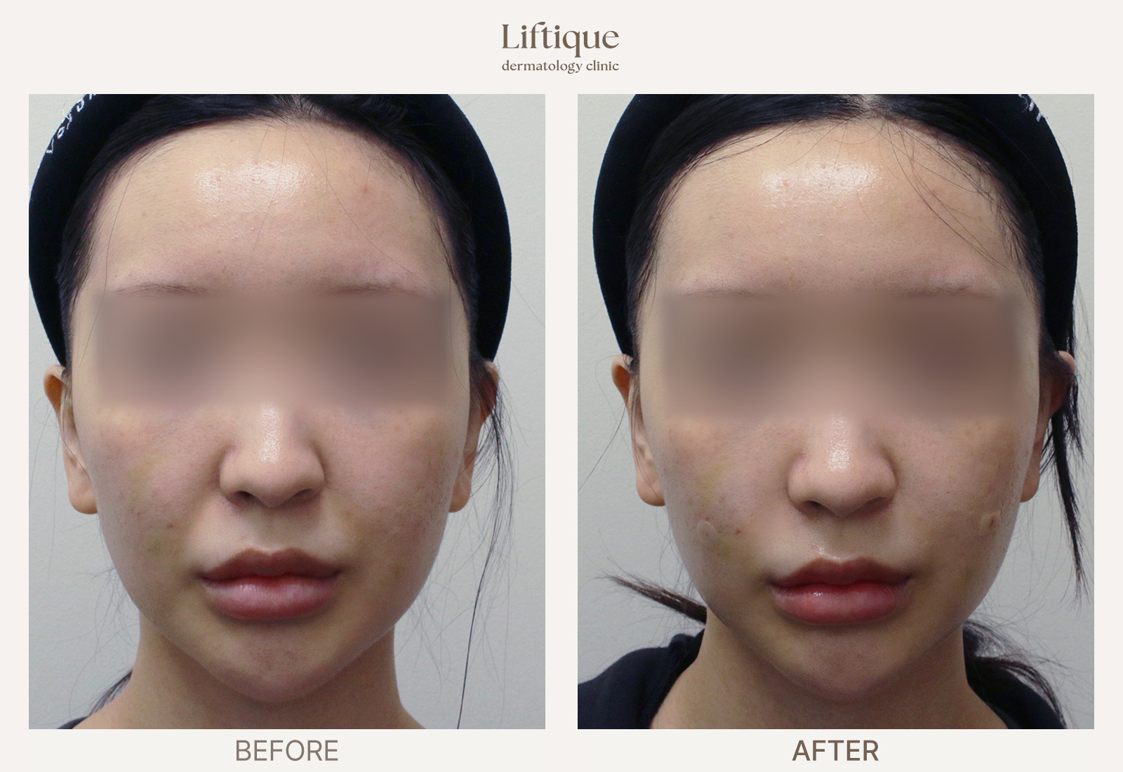 Before-and-after result 3 for Juvelook Volume at Liftique Dermatology Clinic
