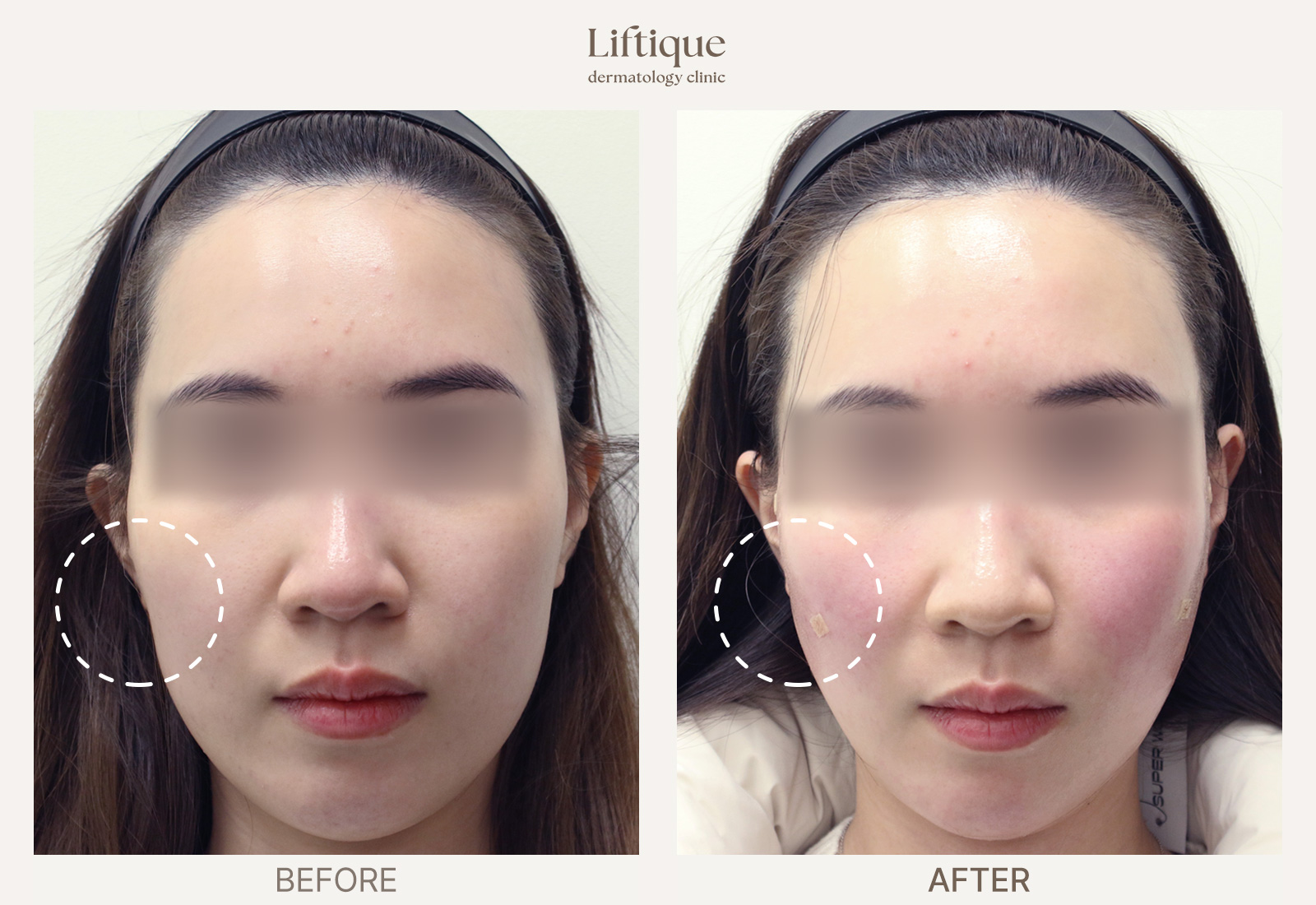 Before-and-after result 5 for Juvelook Volume at Liftique Dermatology Clinic