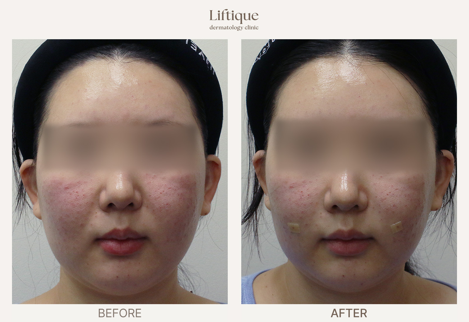 Before-and-after result 6 for Juvelook Volume at Liftique Dermatology Clinic