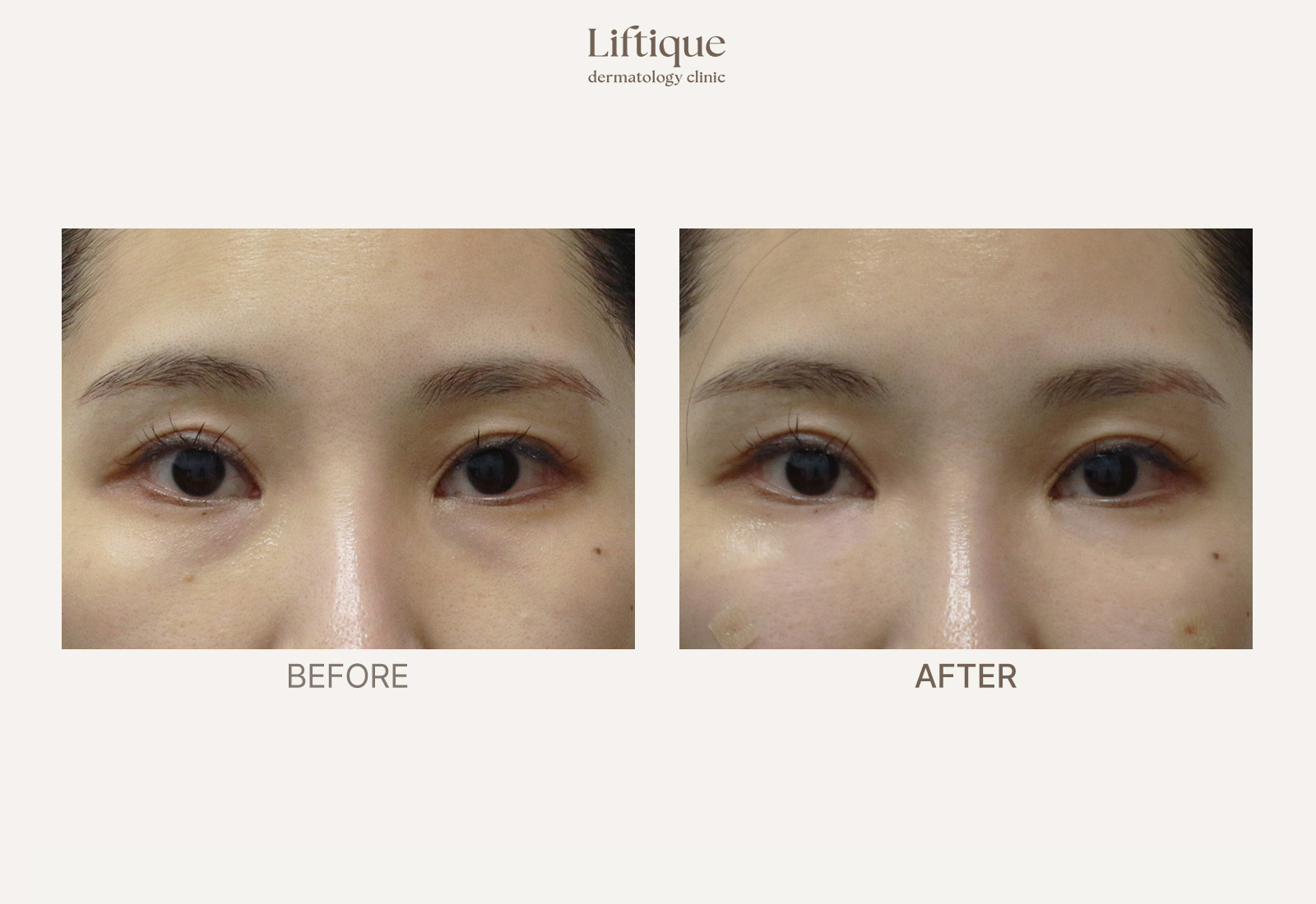 Before-and-after result 1 for Juvelook I at Liftique Dermatology Clinic