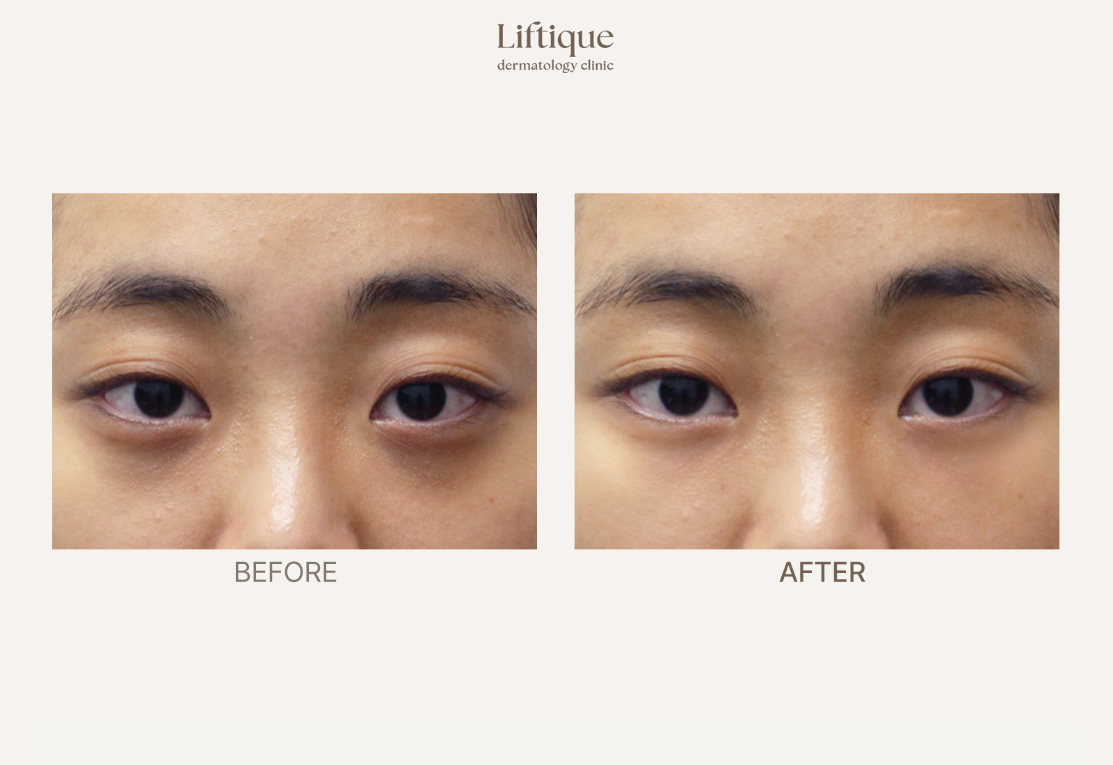 Before-and-after result 2 for Juvelook I at Liftique Dermatology Clinic