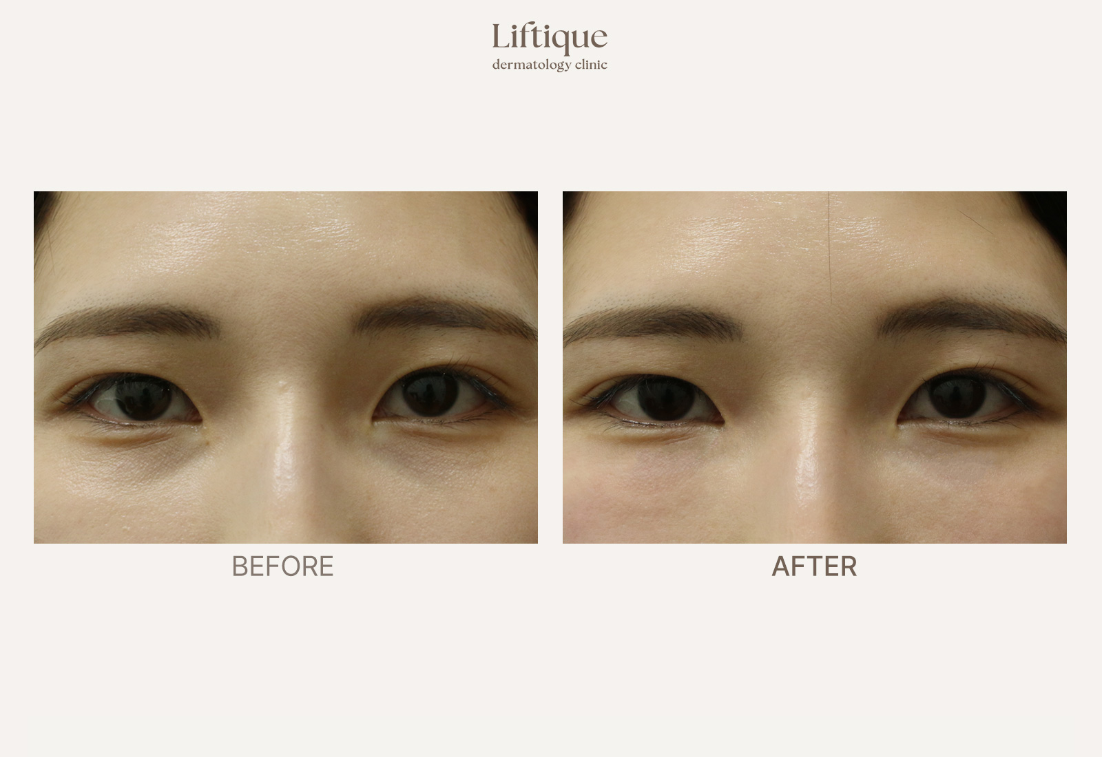 Before-and-after result 3 for Juvelook I at Liftique Dermatology Clinic