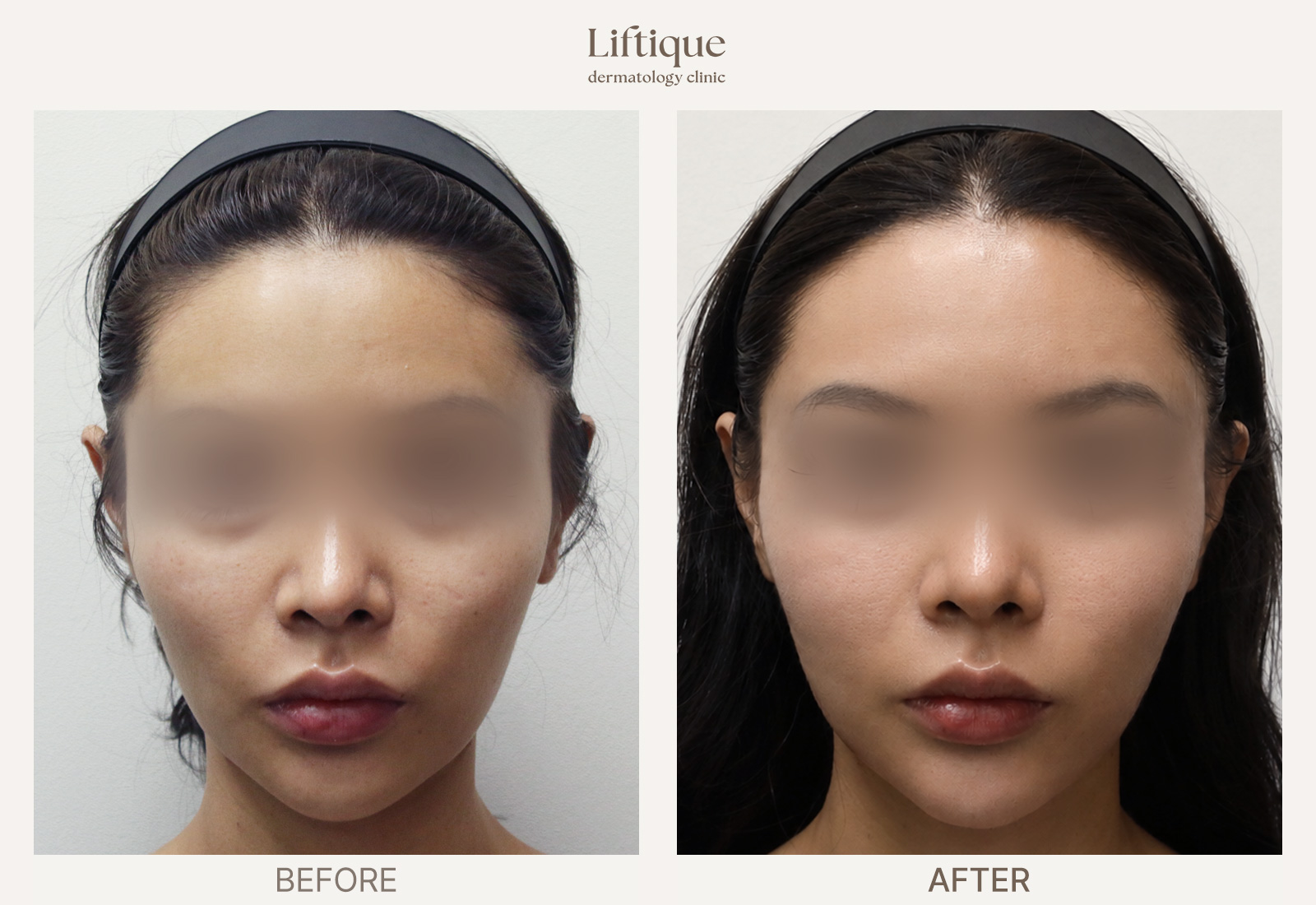 Before-and-after result 1 for Rejuran at Liftique Dermatology Clinic