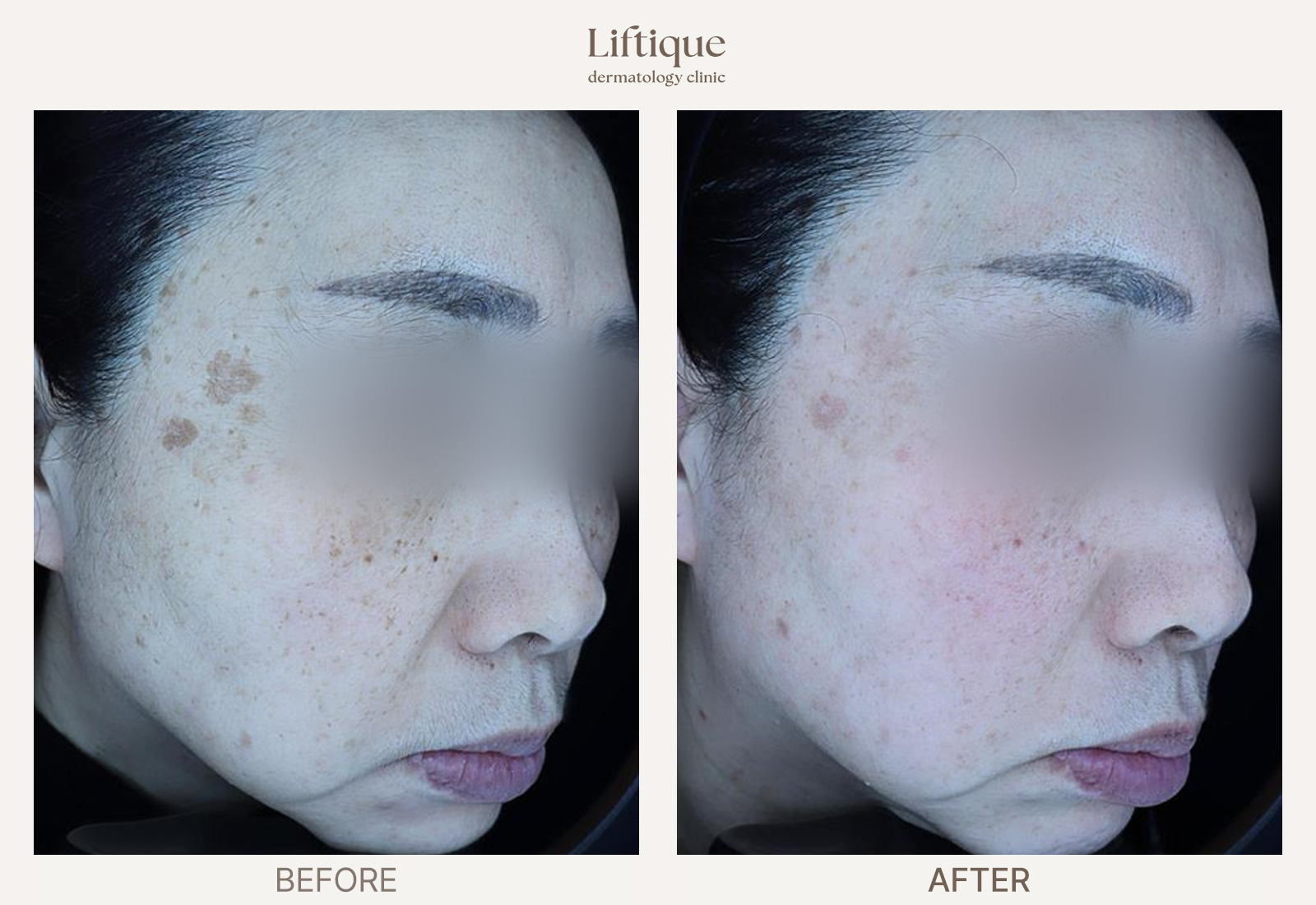 Before-and-after result 3 for Laser Toning at Liftique Dermatology Clinic
