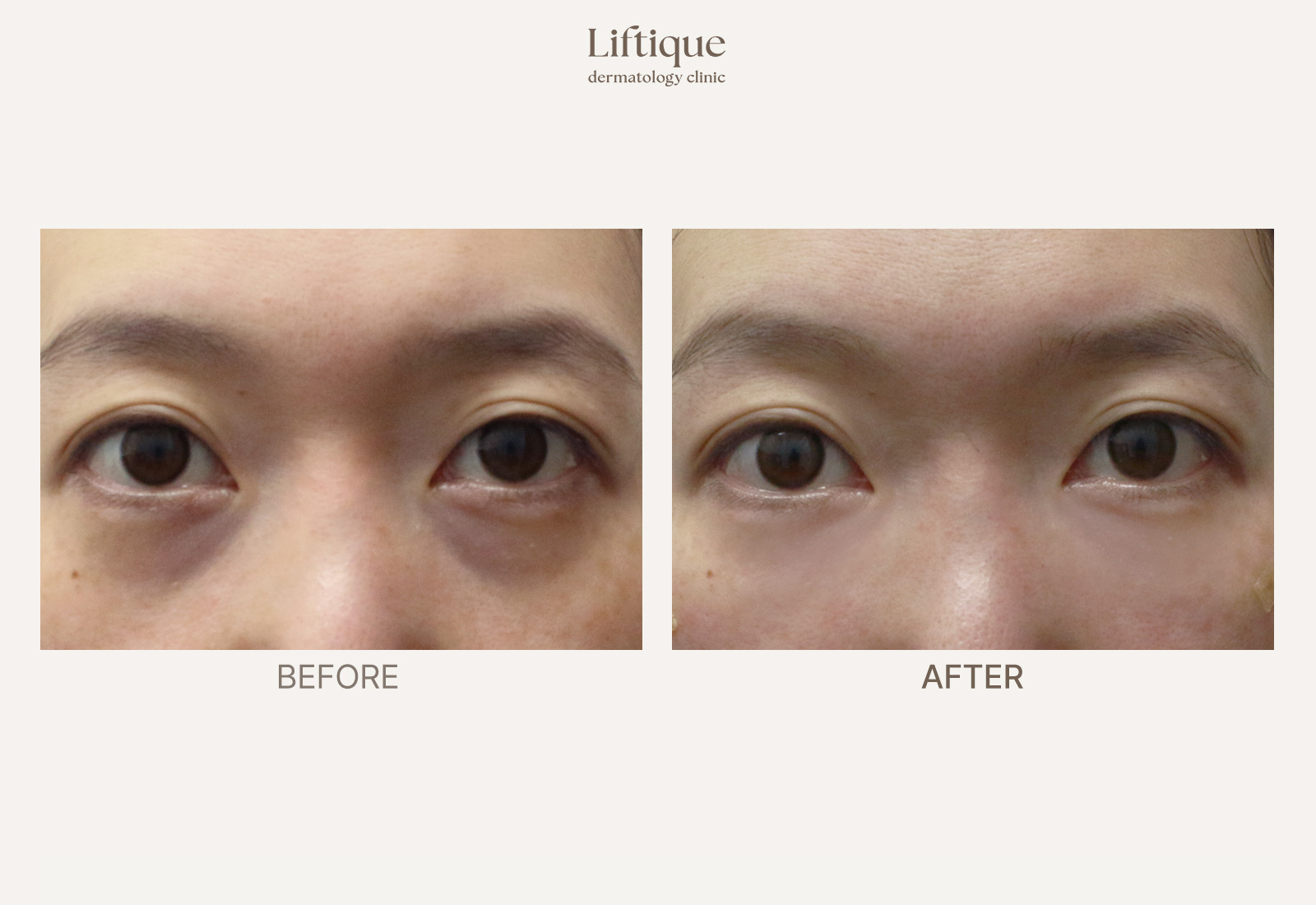 Before-and-after result 4 for Juvelook I at Liftique Dermatology Clinic