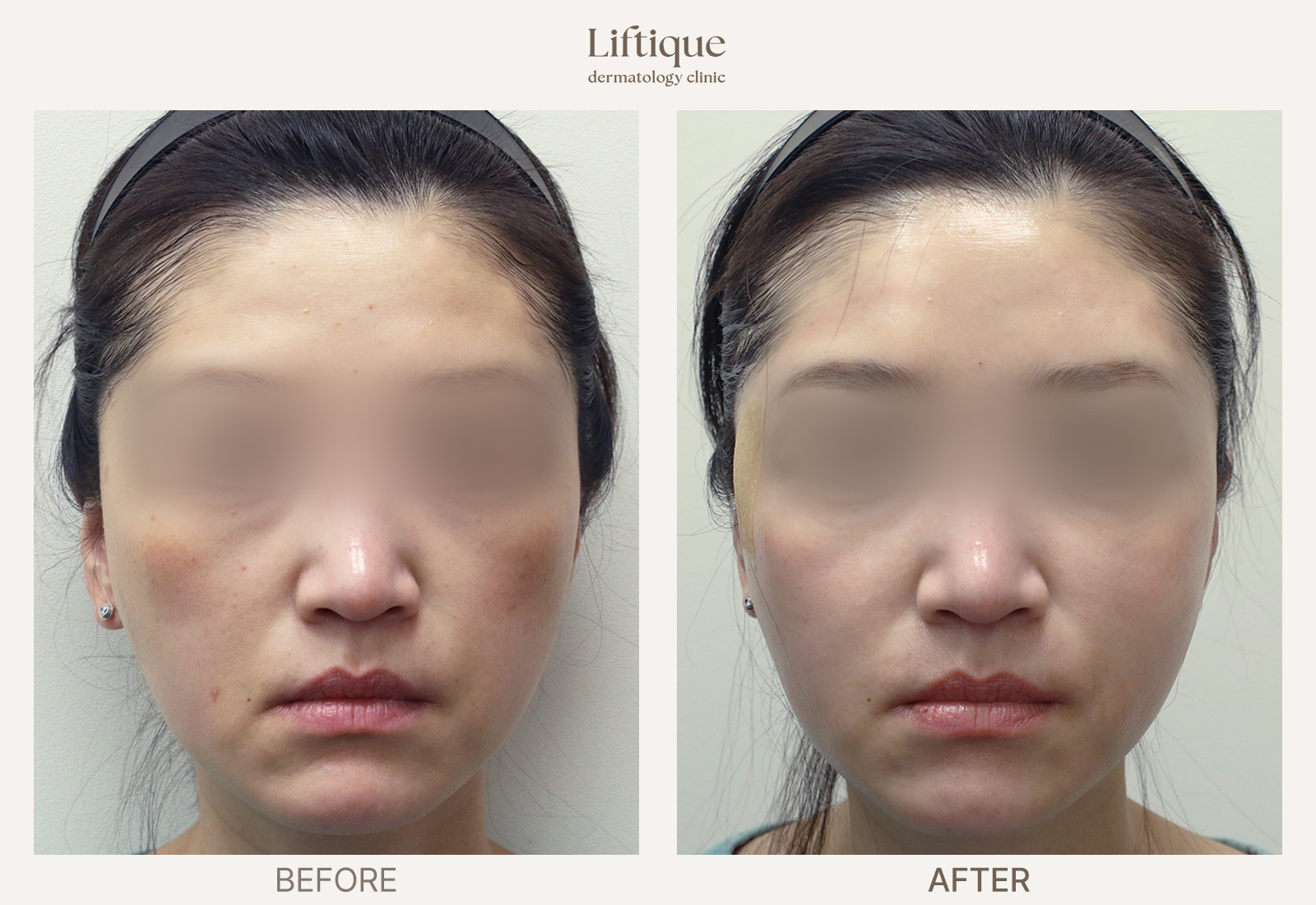 Before-and-after result 1 for Laser Toning at Liftique Dermatology Clinic